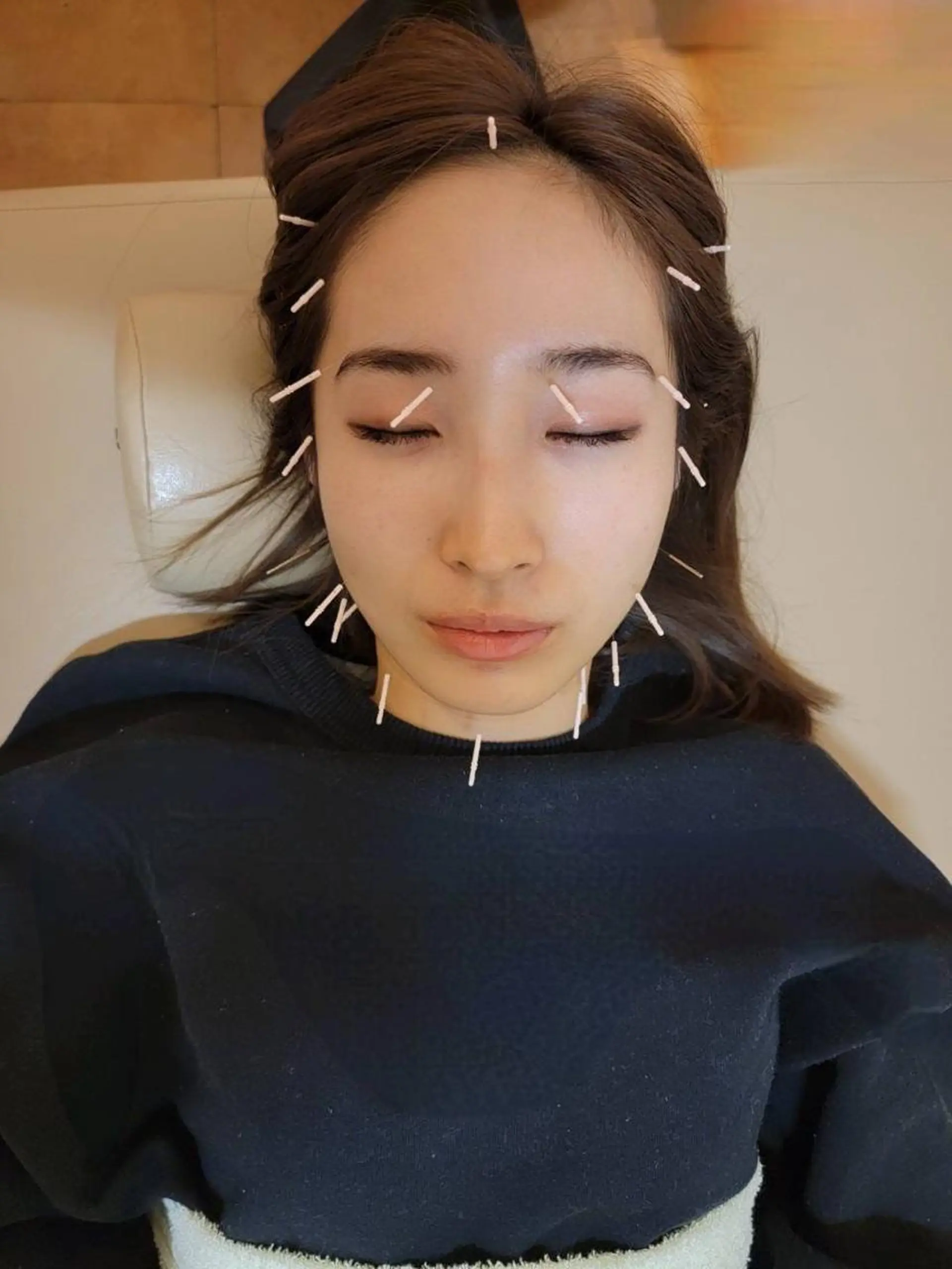 リフトアップ・たるみ ☆美容鍼小顔矯正のその他イメージ