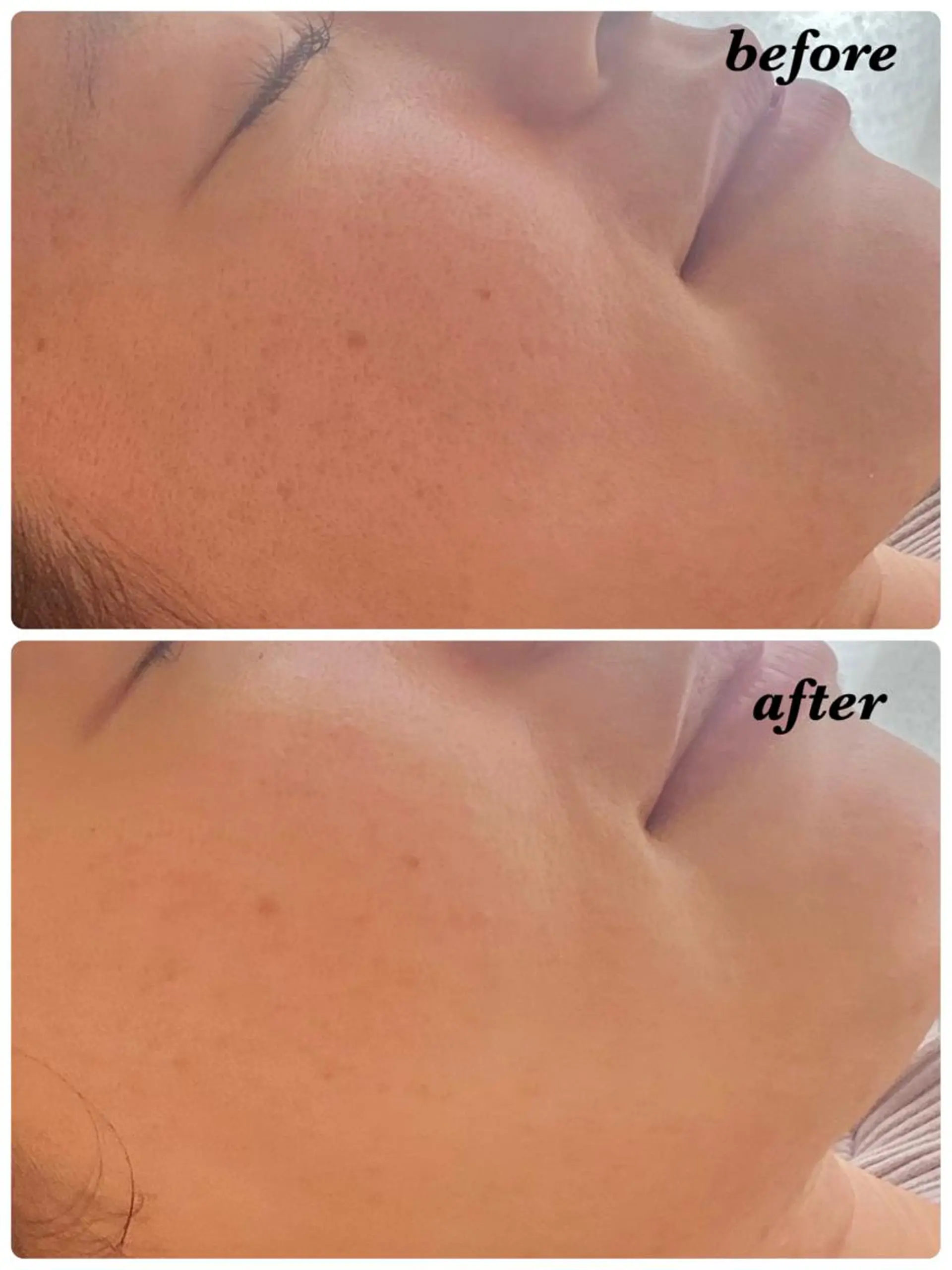 ハーブピーリング/韓国肌管理/フェイシャル/毛穴洗浄/眉毛/顔脱毛【糸脱毛専門】rev所属・ハーブピーリング🌹 毛穴洗浄❤️眉waxのエステ・リラクイメージ