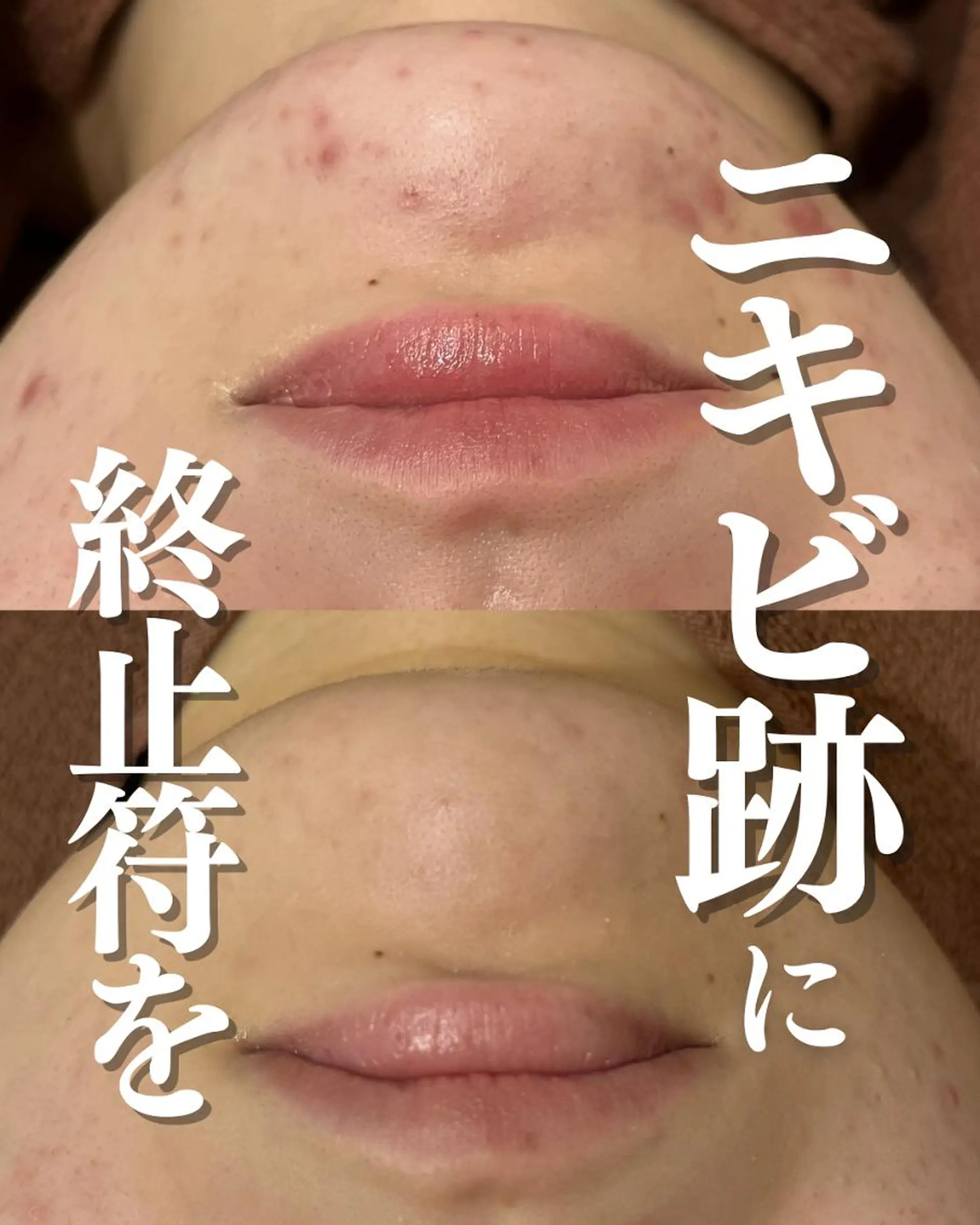 ダウンタイムなし🌷 優しい肌質改善のエステ・リラクイメージ