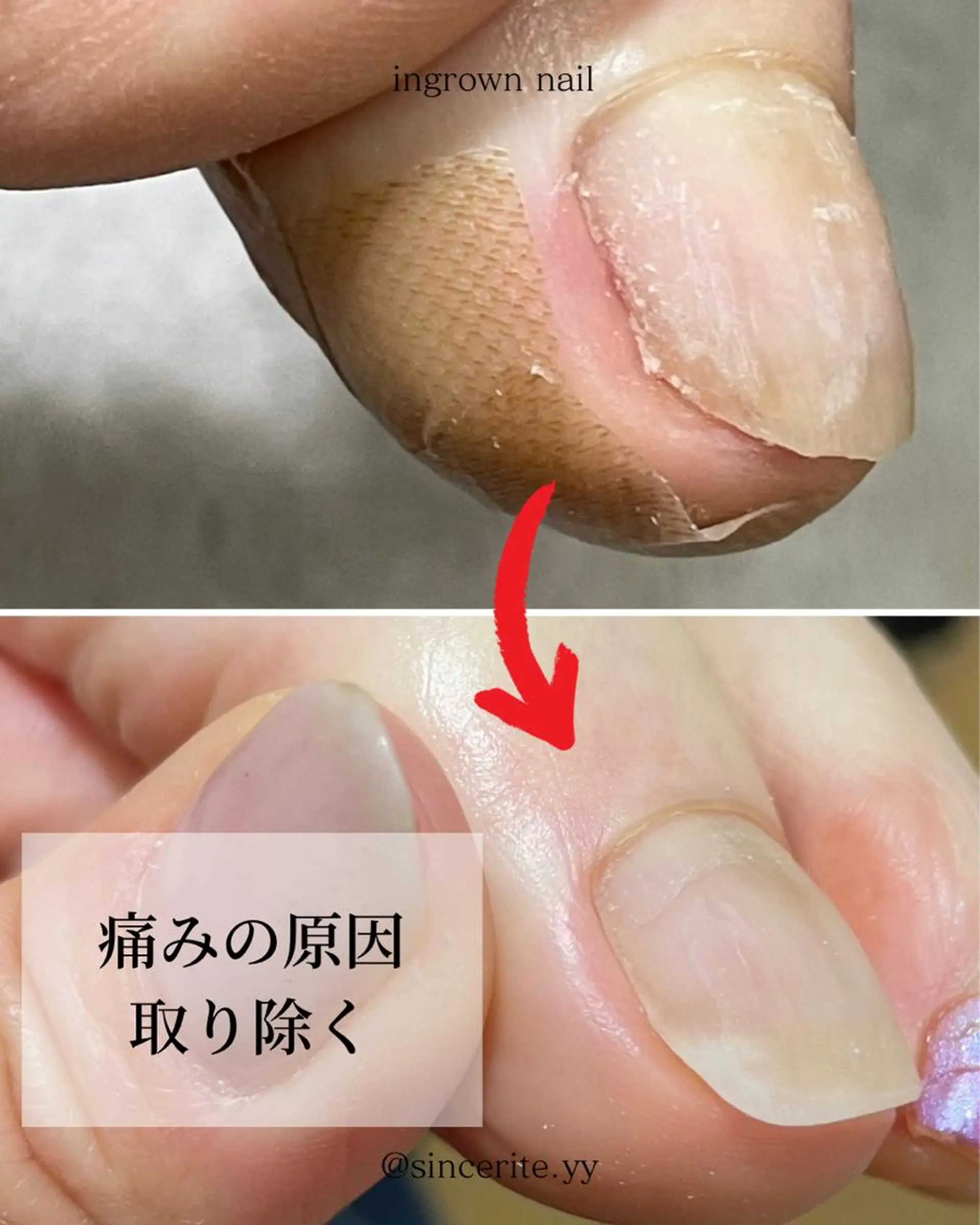 ネイル 深爪・巻き爪 専門サンセリテのネイルデザイン