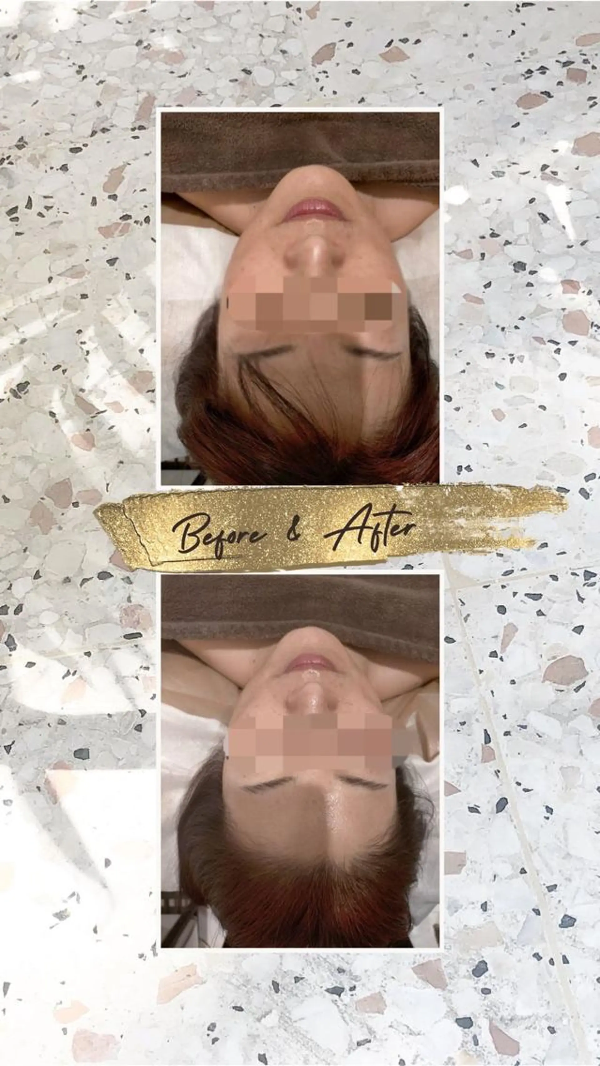 頭蓋骨小顔矯正 ハーブピーリングのエステ・リラクイメージ