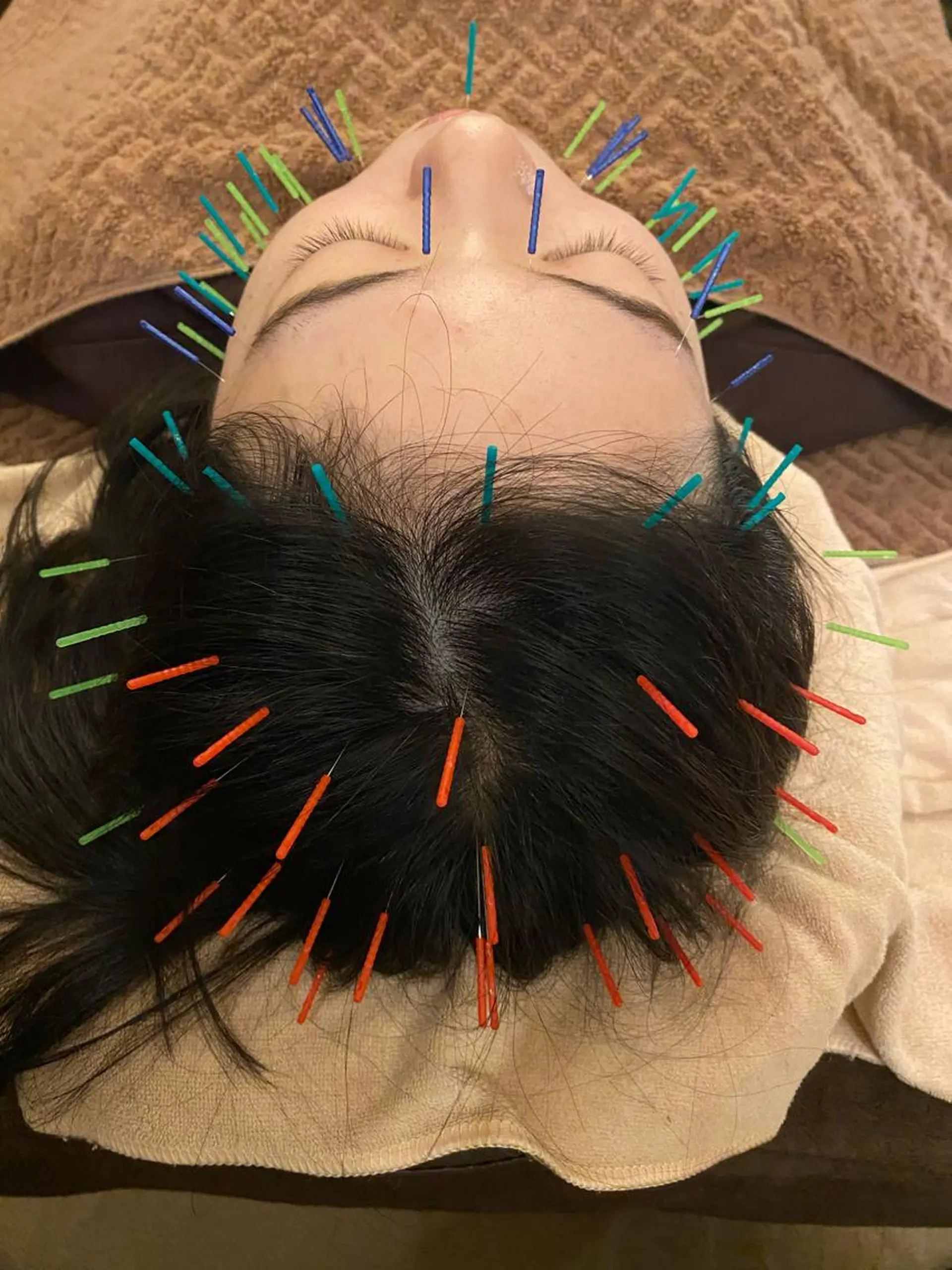 Acupuncture  salon LINOA リノア鍼灸院所属・ヘッドスパ鍼/小顔鍼 EMS LINOAのエステ・リラクイメージ