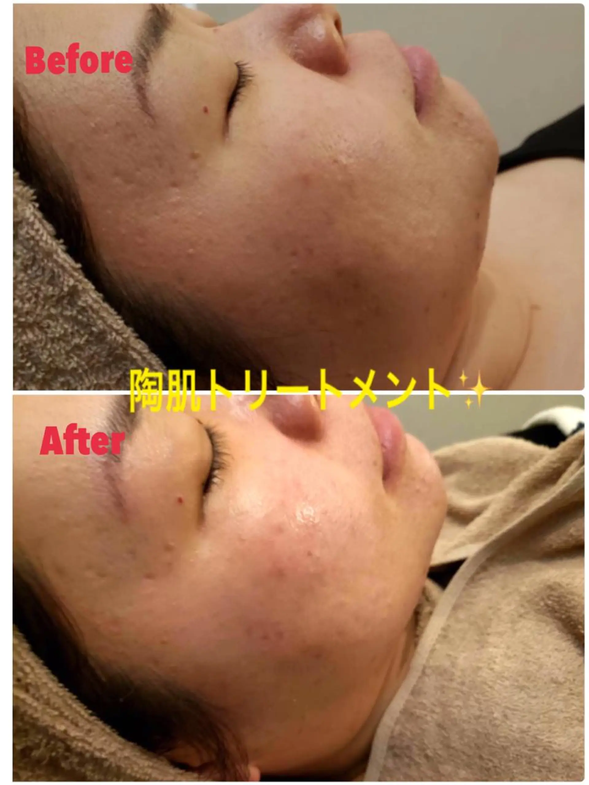 エステ 【リベルハーブピーリング認定店】敏感肌・美白脱毛専門店Dione立川店所属・Dione 立川店のエステ・リラクイメージ