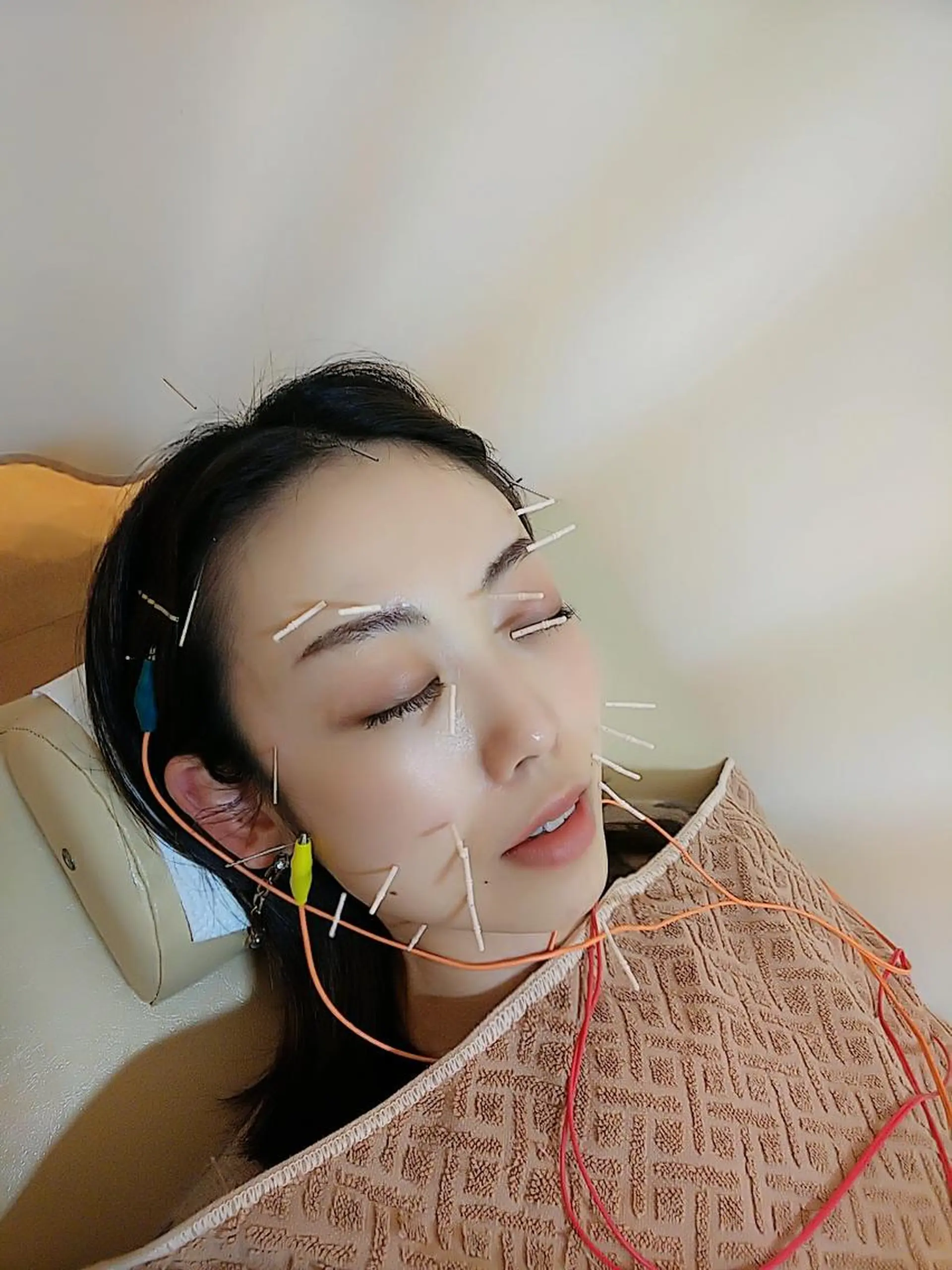 リフトアップ・たるみ ☆美容鍼小顔矯正のその他イメージ