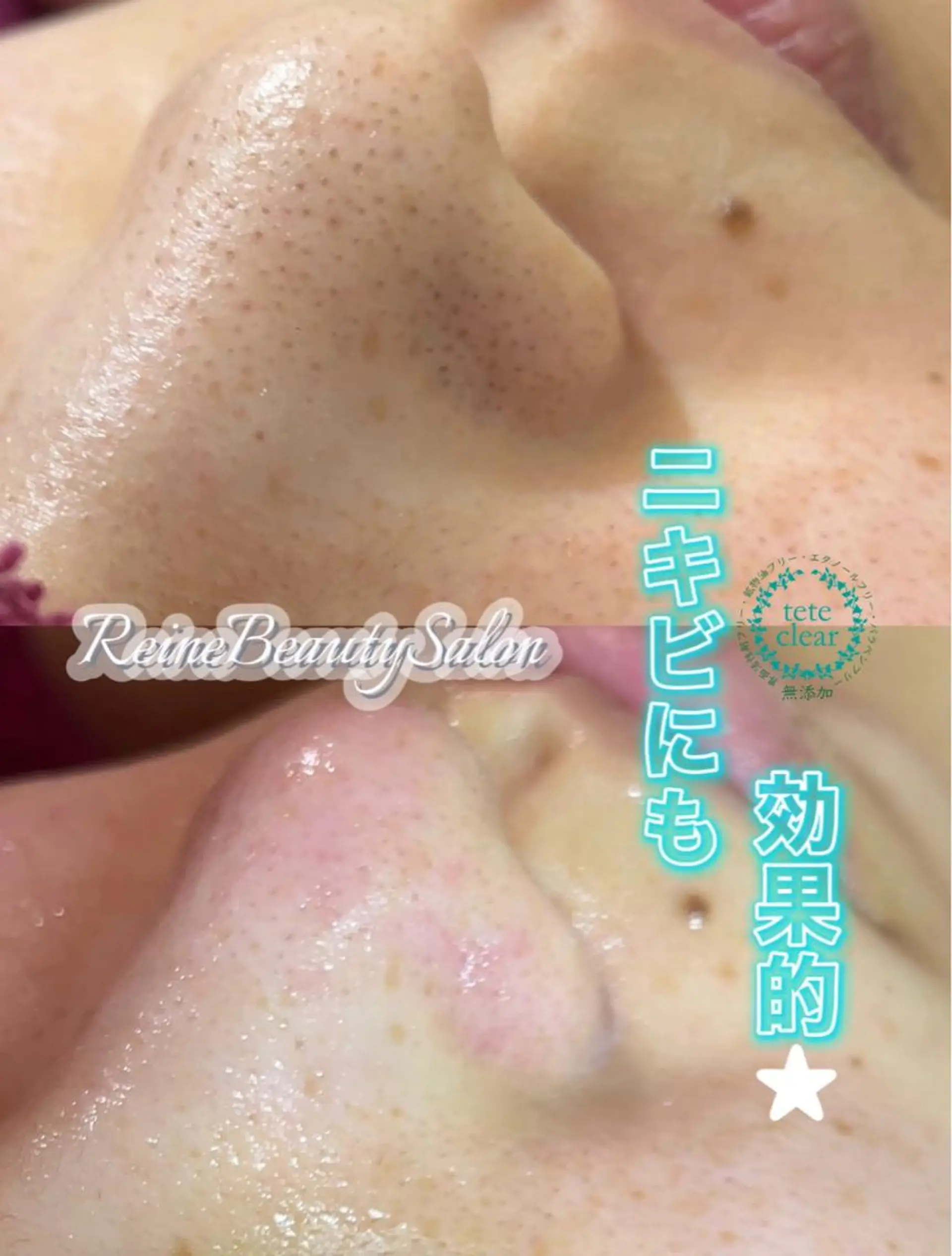 エステ Reine BeautySalon所属・毛穴/シミ肝斑/脱毛 横山梨里のエステ・リラクイメージ