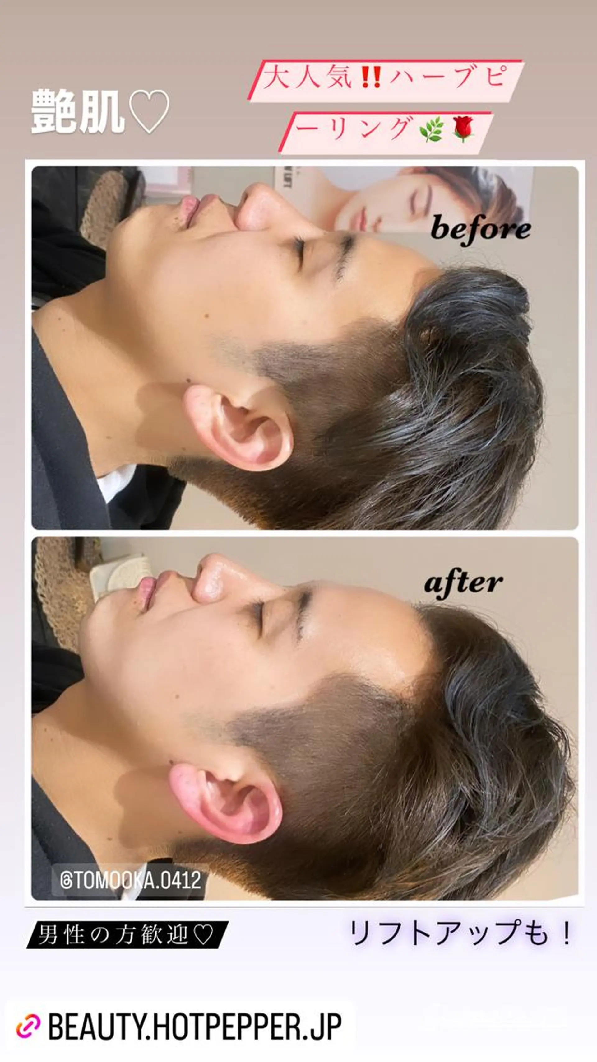 ハーブピーリング/韓国肌管理/フェイシャル/毛穴洗浄/眉毛/顔脱毛【糸脱毛専門】rev所属・ハーブピーリング🌹 毛穴洗浄❤️眉waxのエステ・リラクイメージ