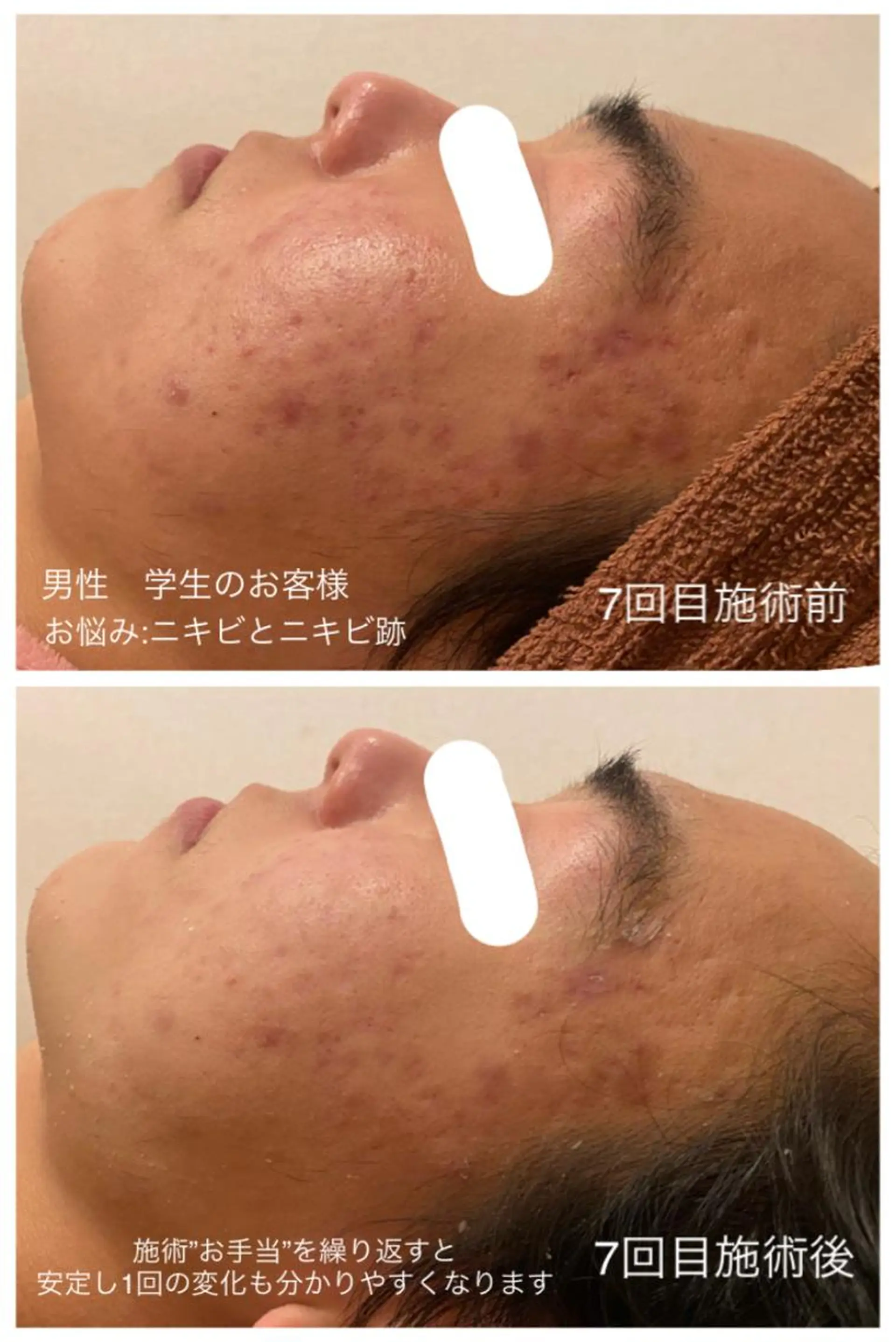 エステ リラク 夏までに肌荒れ卒業 するサロン🌻のエステ・リラクイメージ