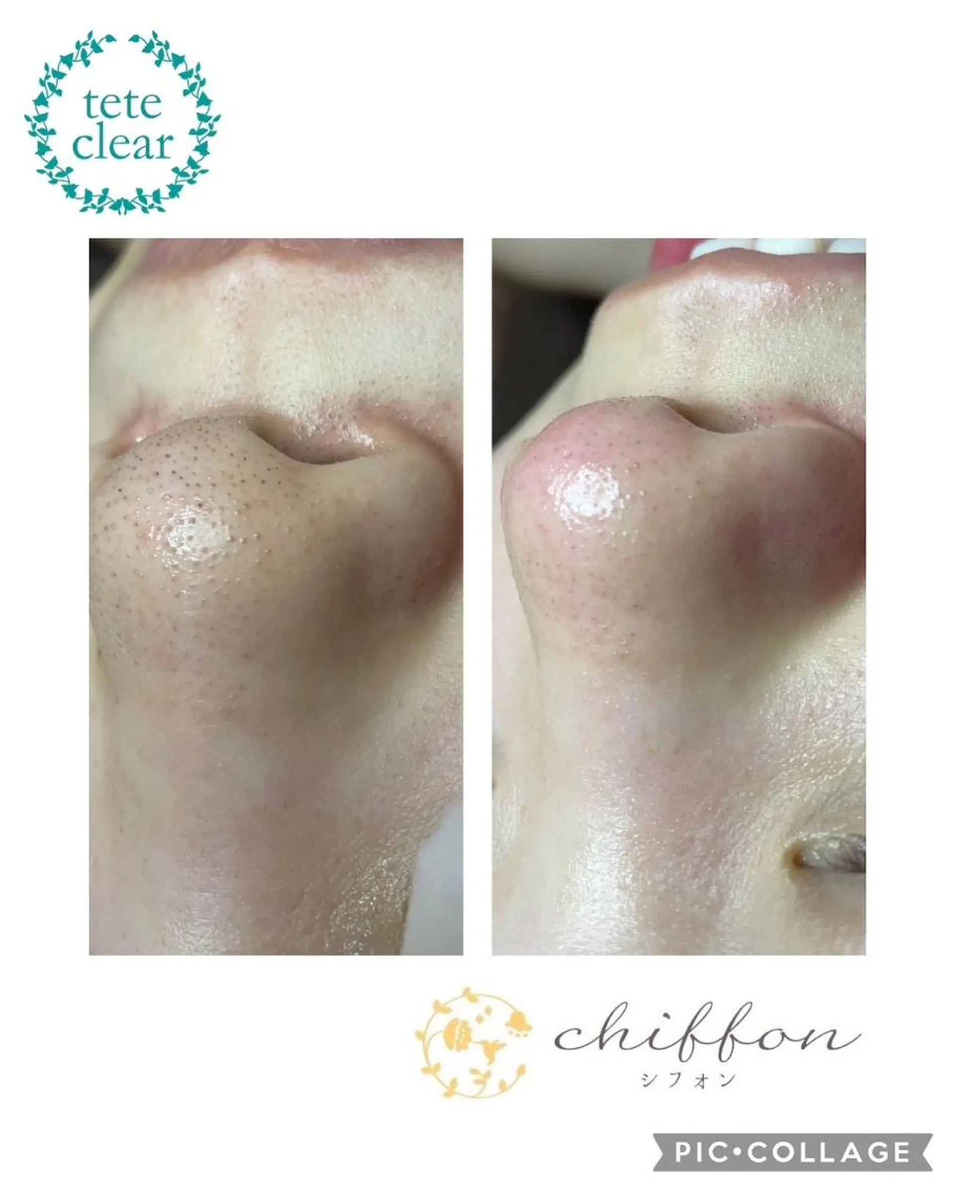 エステ 毛穴黒ずみ改善🥇 ✨シフォン豊田✨のエステ・リラクイメージ