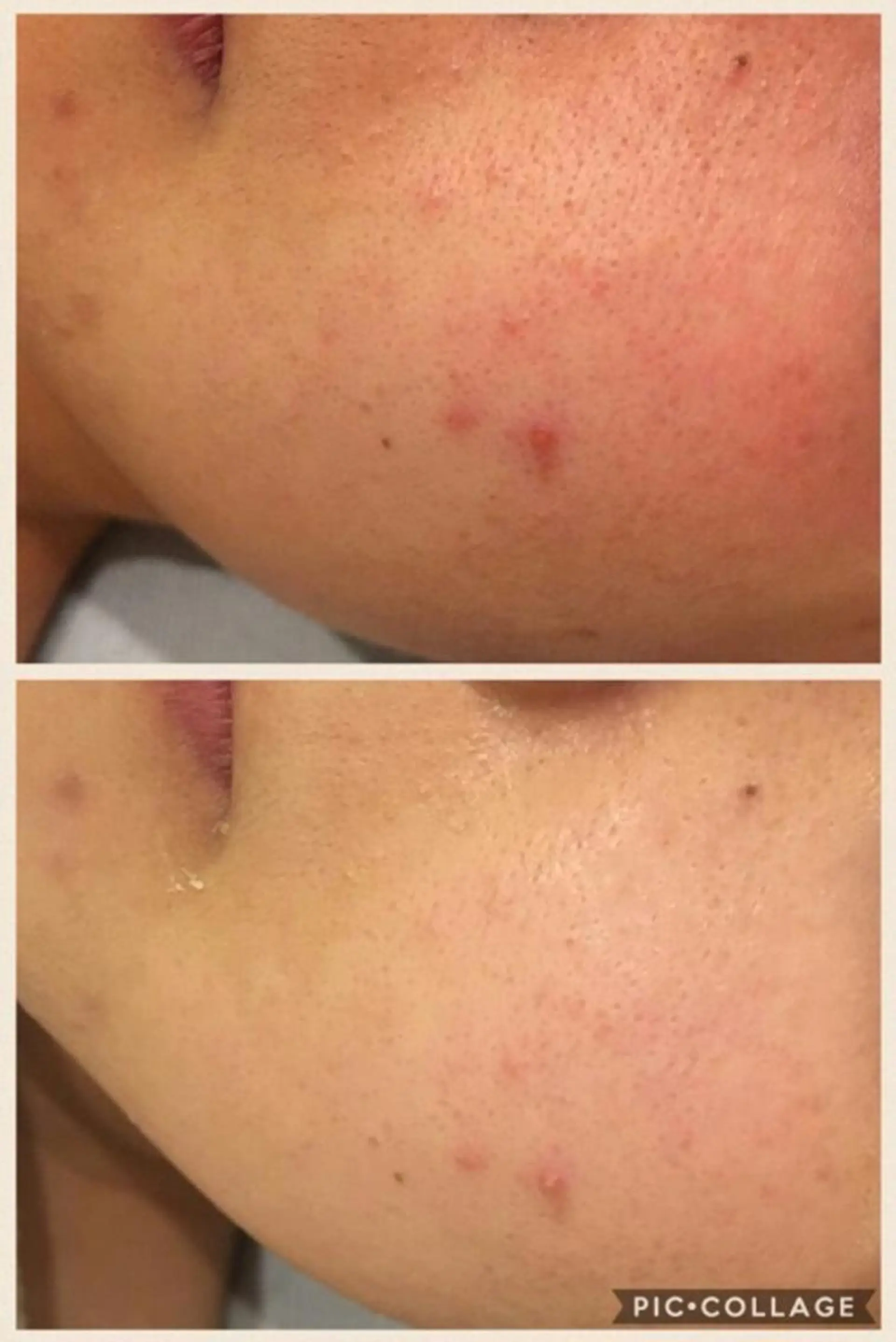 夏までに肌荒れ卒業 するサロン🌻のエステ・リラクイメージ