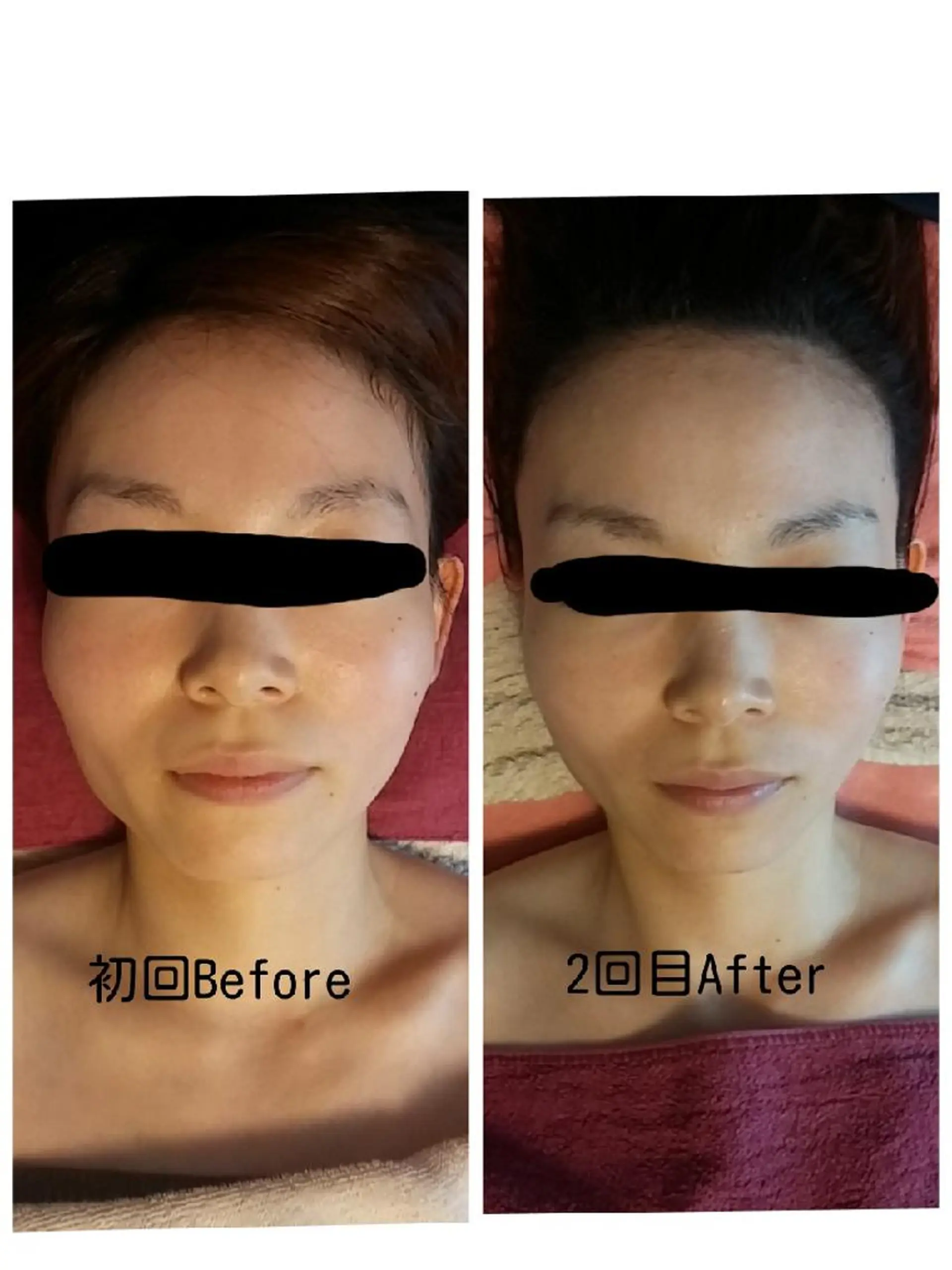 毛穴ケア くすみ肌 ハーブピーリングのエステ・リラクイメージ