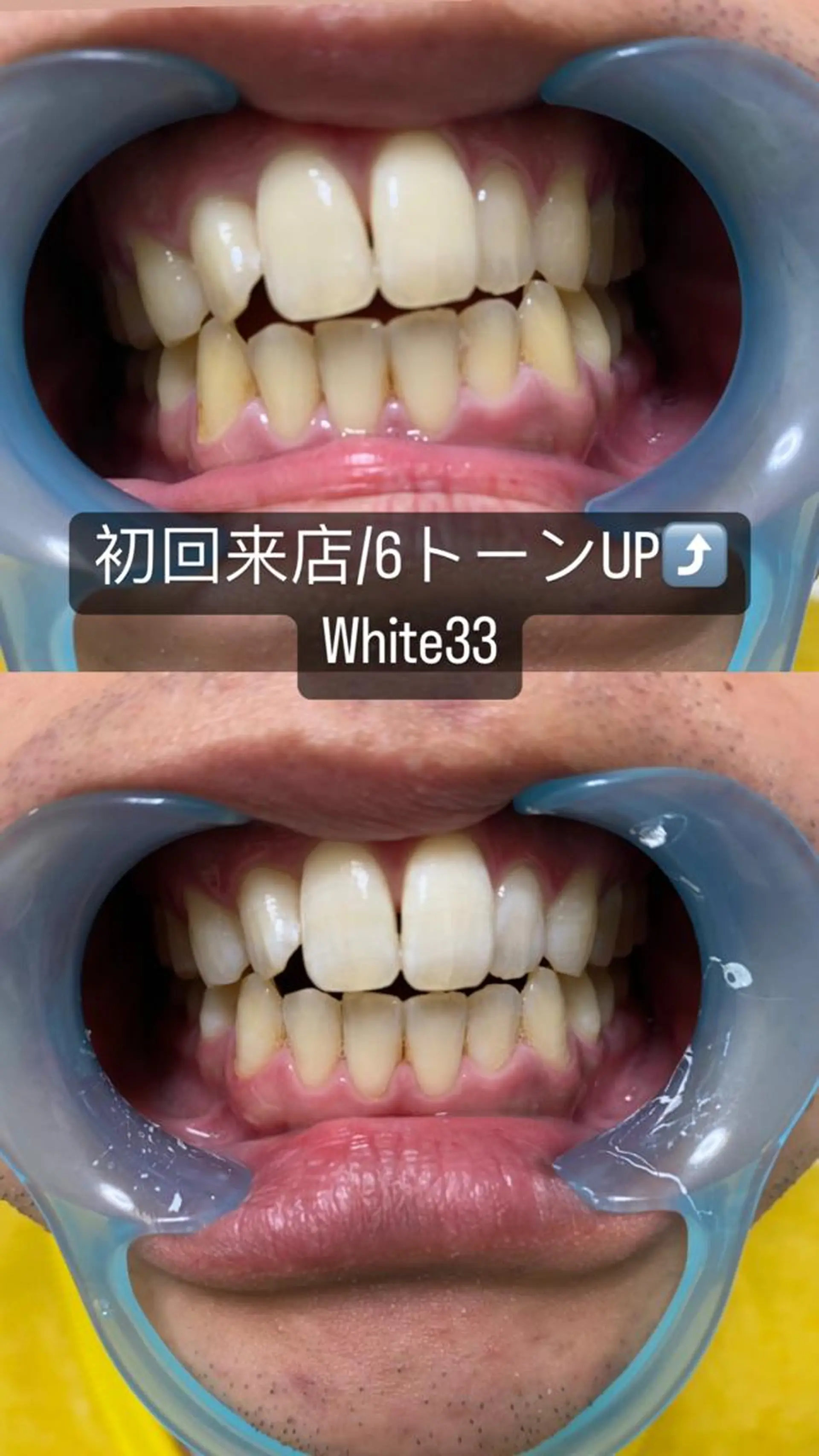 メンズ セルフホワイトニング White33大名のその他イメージ
