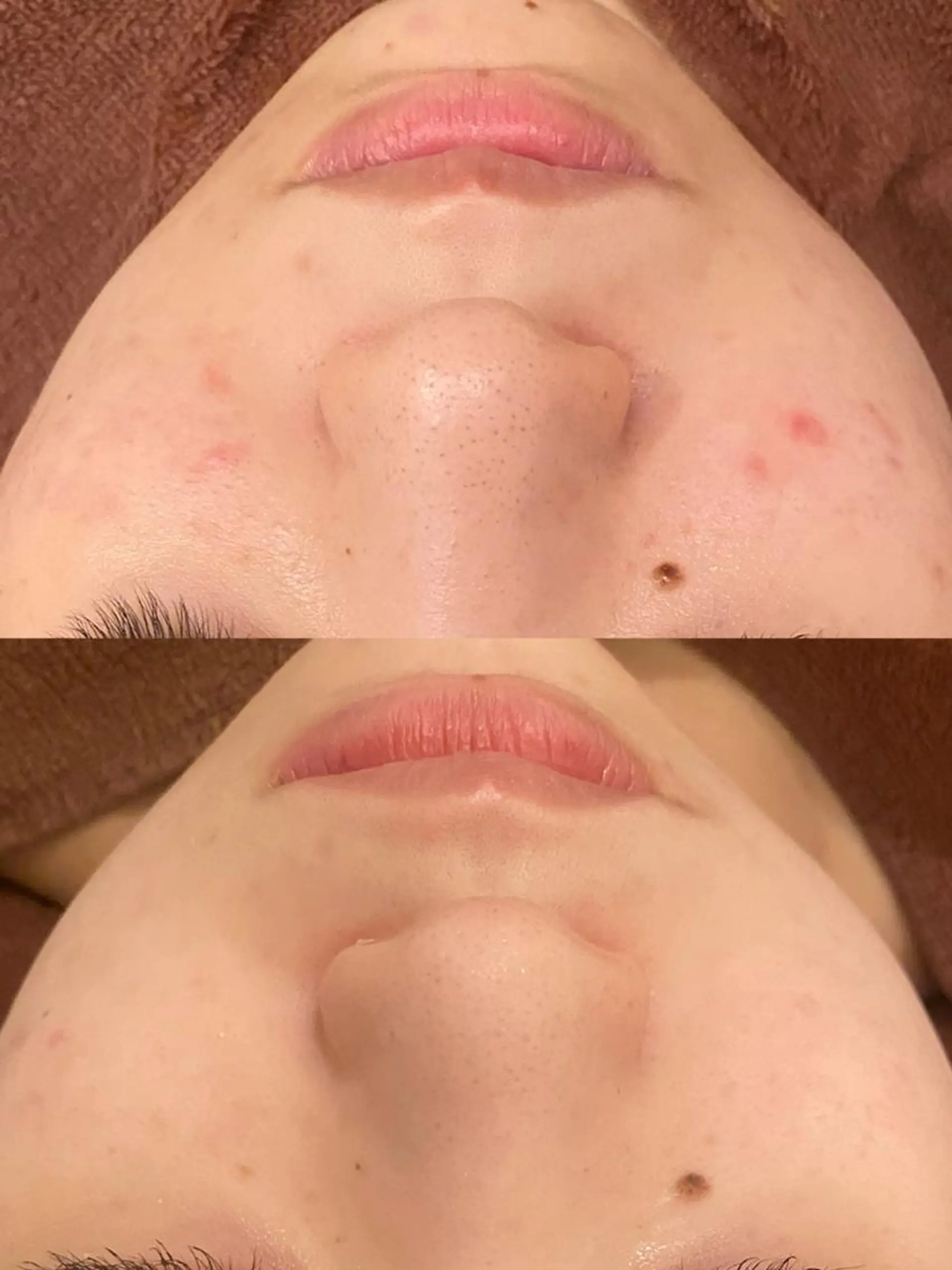 エステ リラク 🔥3か月で肌革命 🔥ニキビ専門店のエステ・リラクイメージ