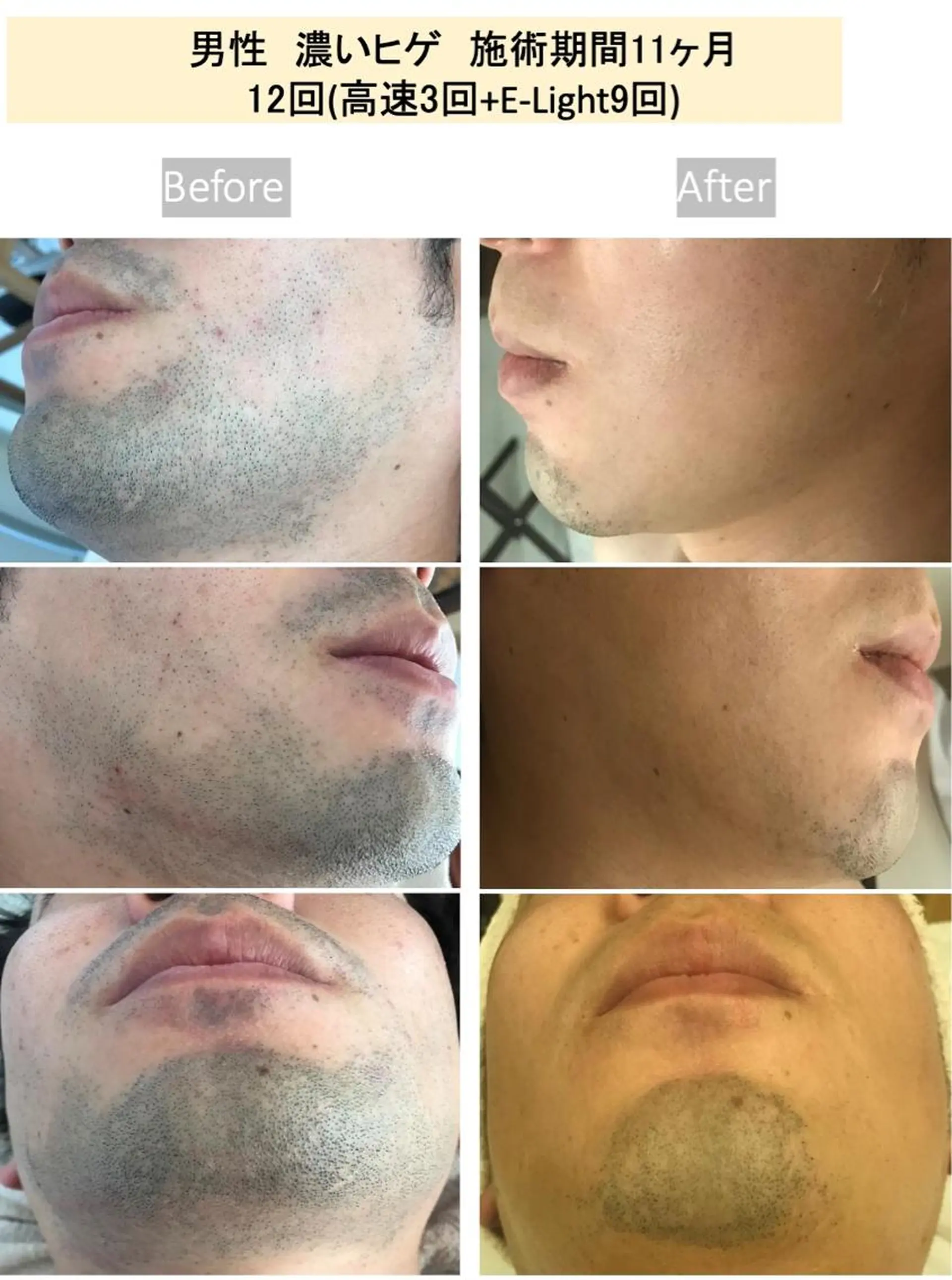 メンズ 美肌脱毛i所属・美肌脱毛ｉ ｜泉大津のエステ・リラクイメージ