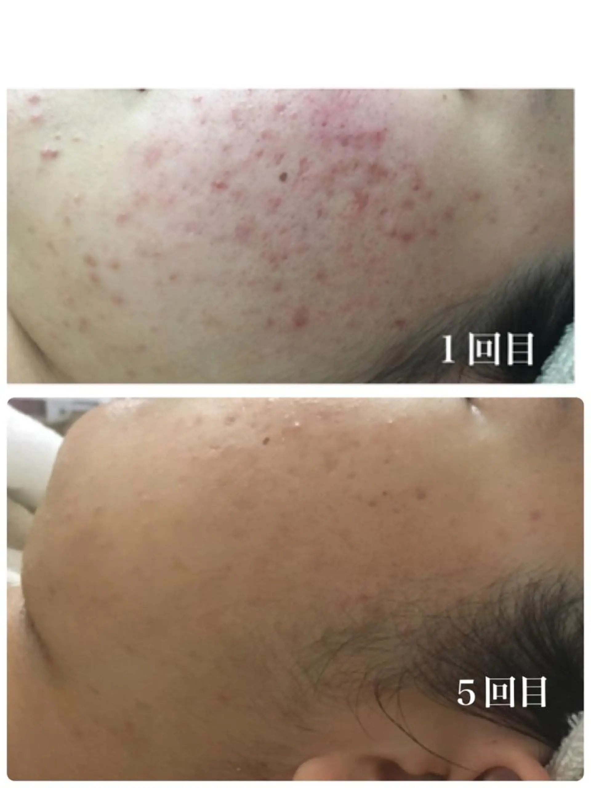 Meupニキビ専門店 背中/ハーブ/肌管理のその他イメージ