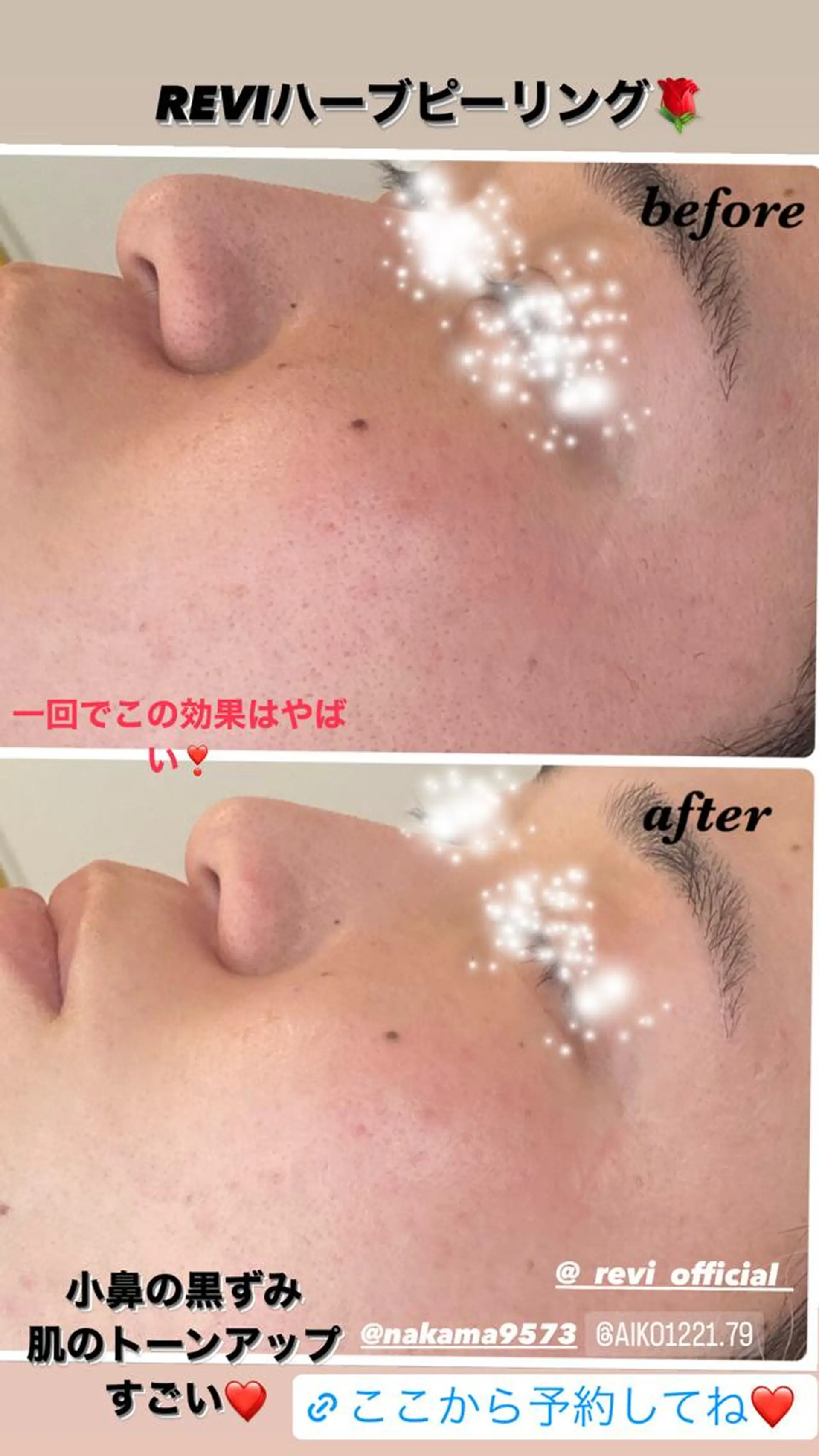 ハーブピーリング/韓国肌管理/フェイシャル/毛穴洗浄/眉毛/顔脱毛【糸脱毛専門】rev所属・ハーブピーリング🌹 毛穴洗浄❤️眉waxのエステ・リラクイメージ