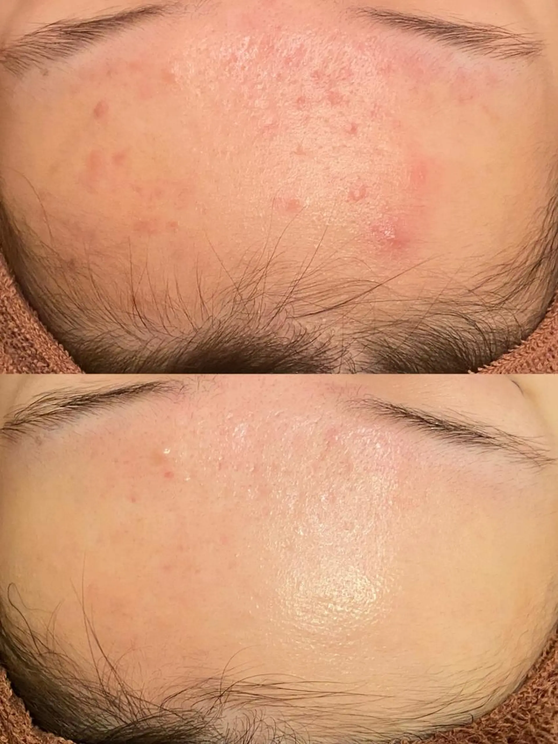 エステ リラク ニキビ跡改善専門🔥 医療にはできない改善のエステ・リラクイメージ