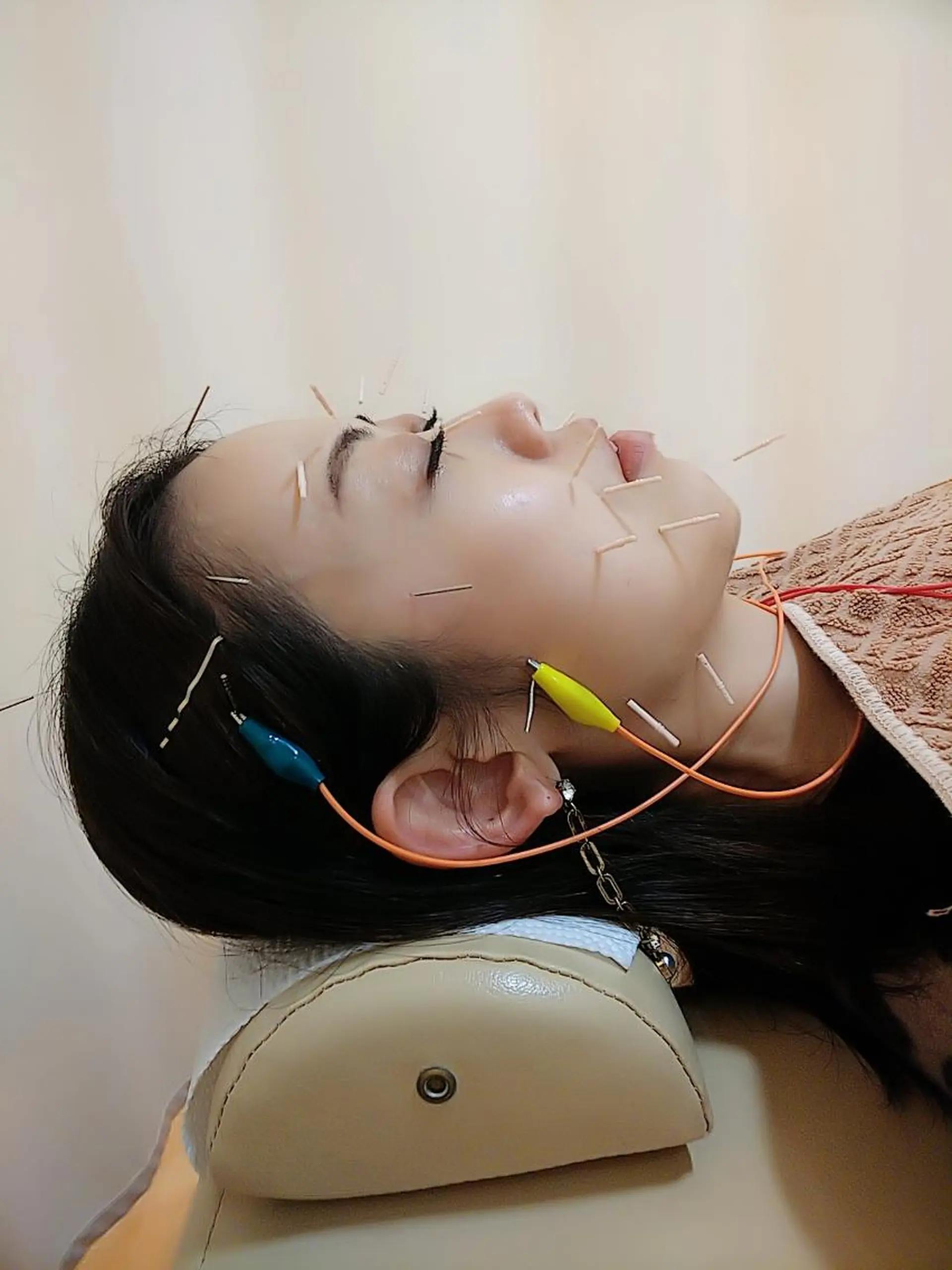 リフトアップ・たるみ ☆美容鍼小顔矯正のその他イメージ