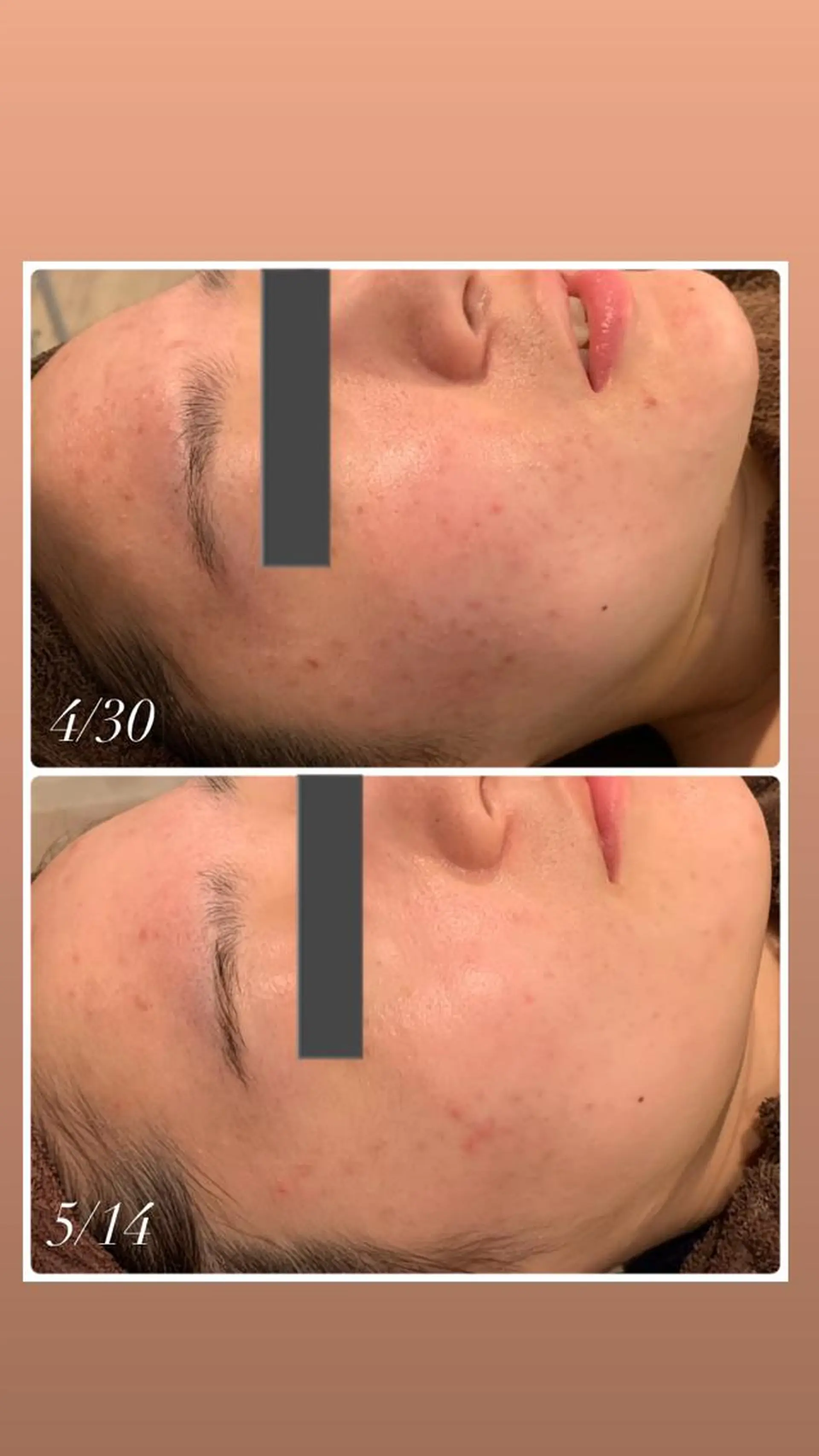 肌質改善ハーブピー リング🌿RINAのエステ・リラクイメージ