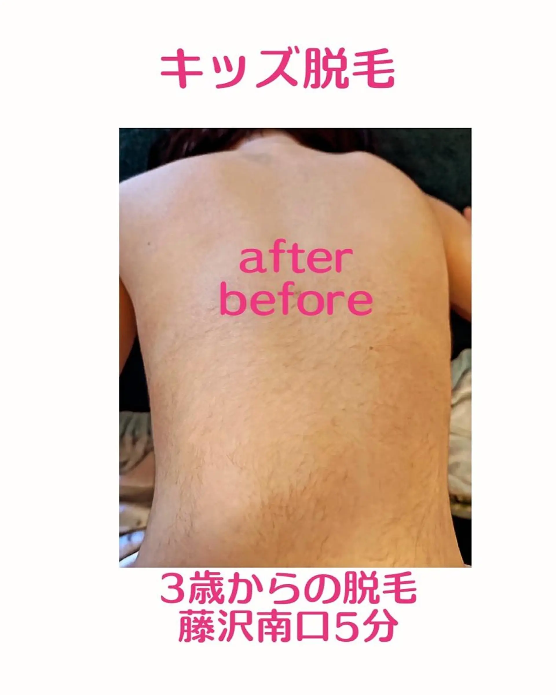 キッズ 脱毛 3歳~フォト美肌脱毛 Dione湘南藤沢店のエステ・リラクイメージ