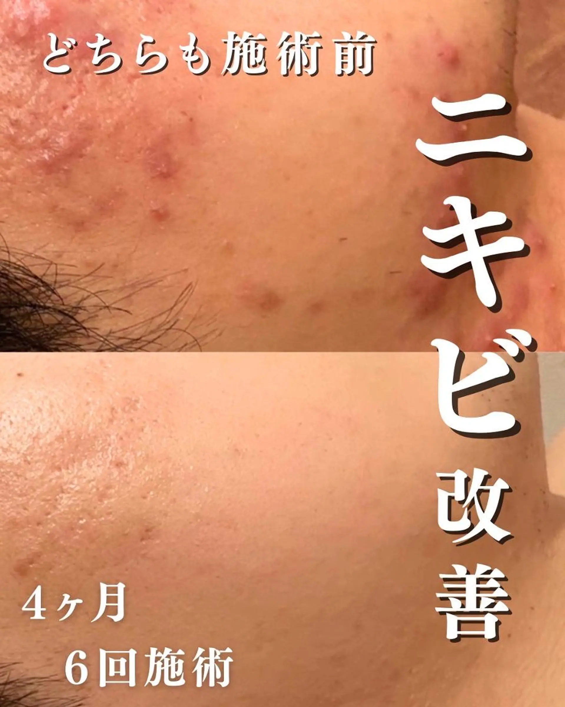 都内で出来る肌管理! 最短ニキビ改善のエステ・リラクイメージ