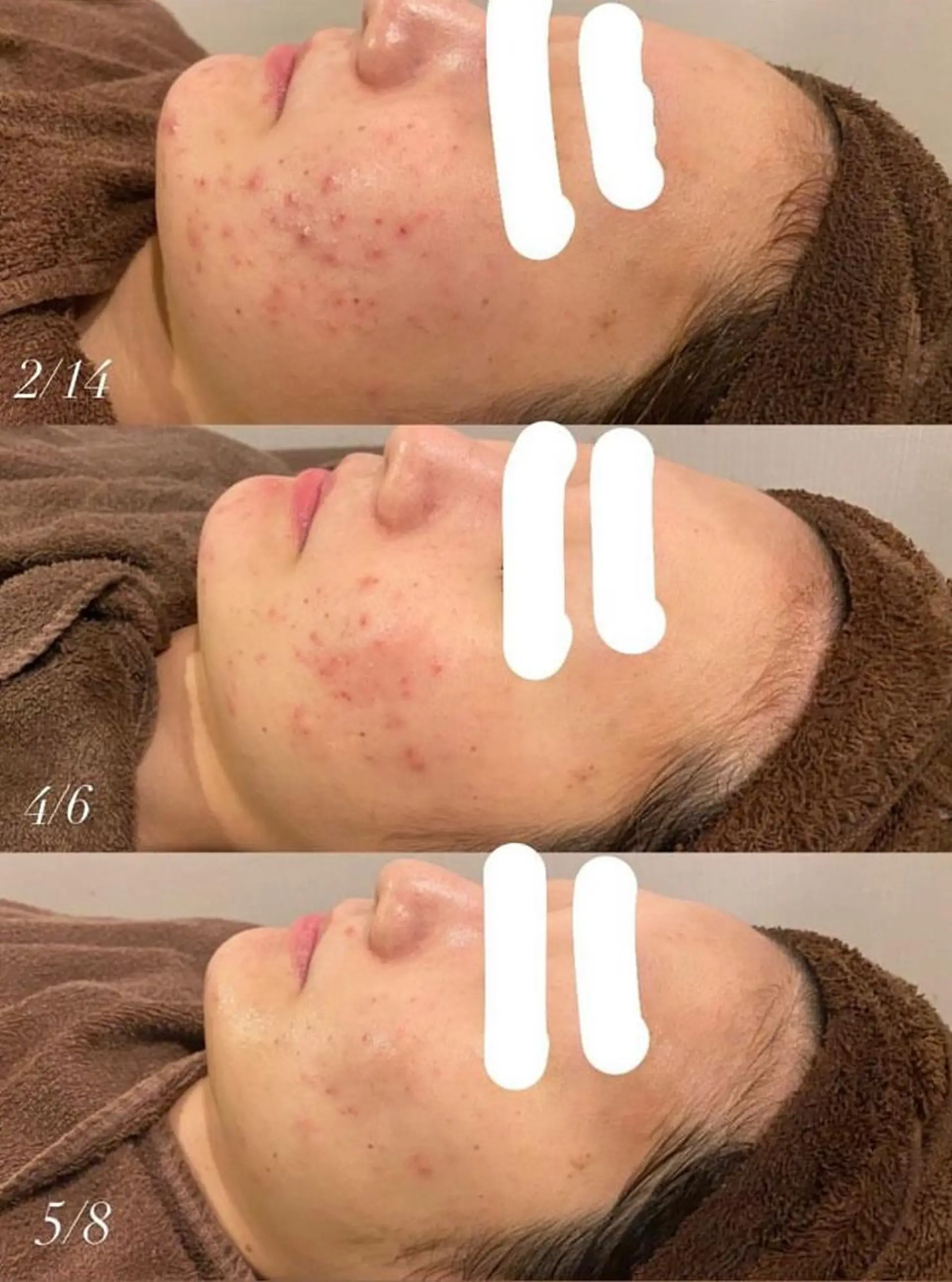 エステ リラク 肌質改善ハーブピー リング🌿RINAのエステ・リラクイメージ