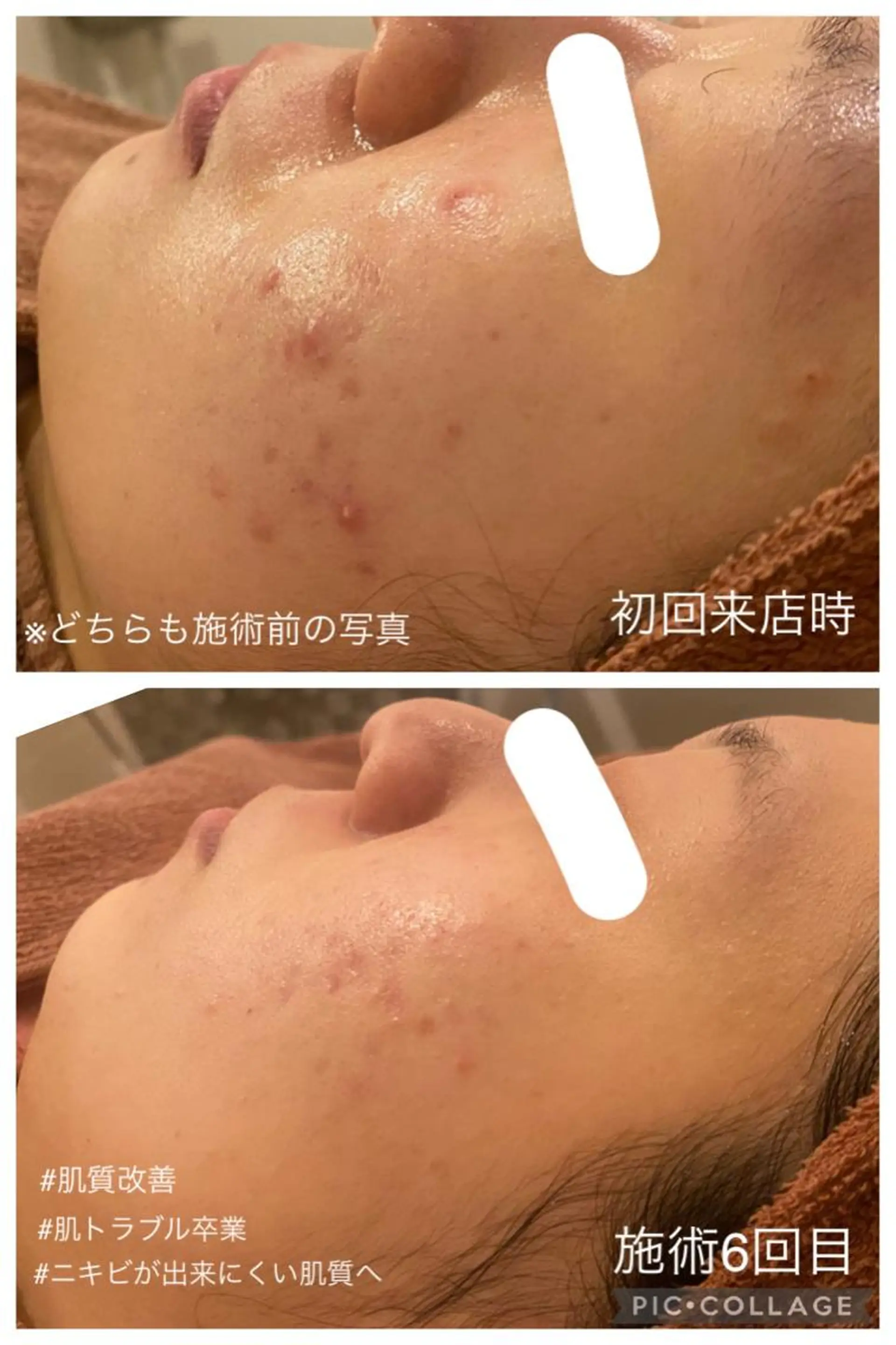 エステ リラク 夏までに肌荒れ卒業 するサロン🌻のエステ・リラクイメージ