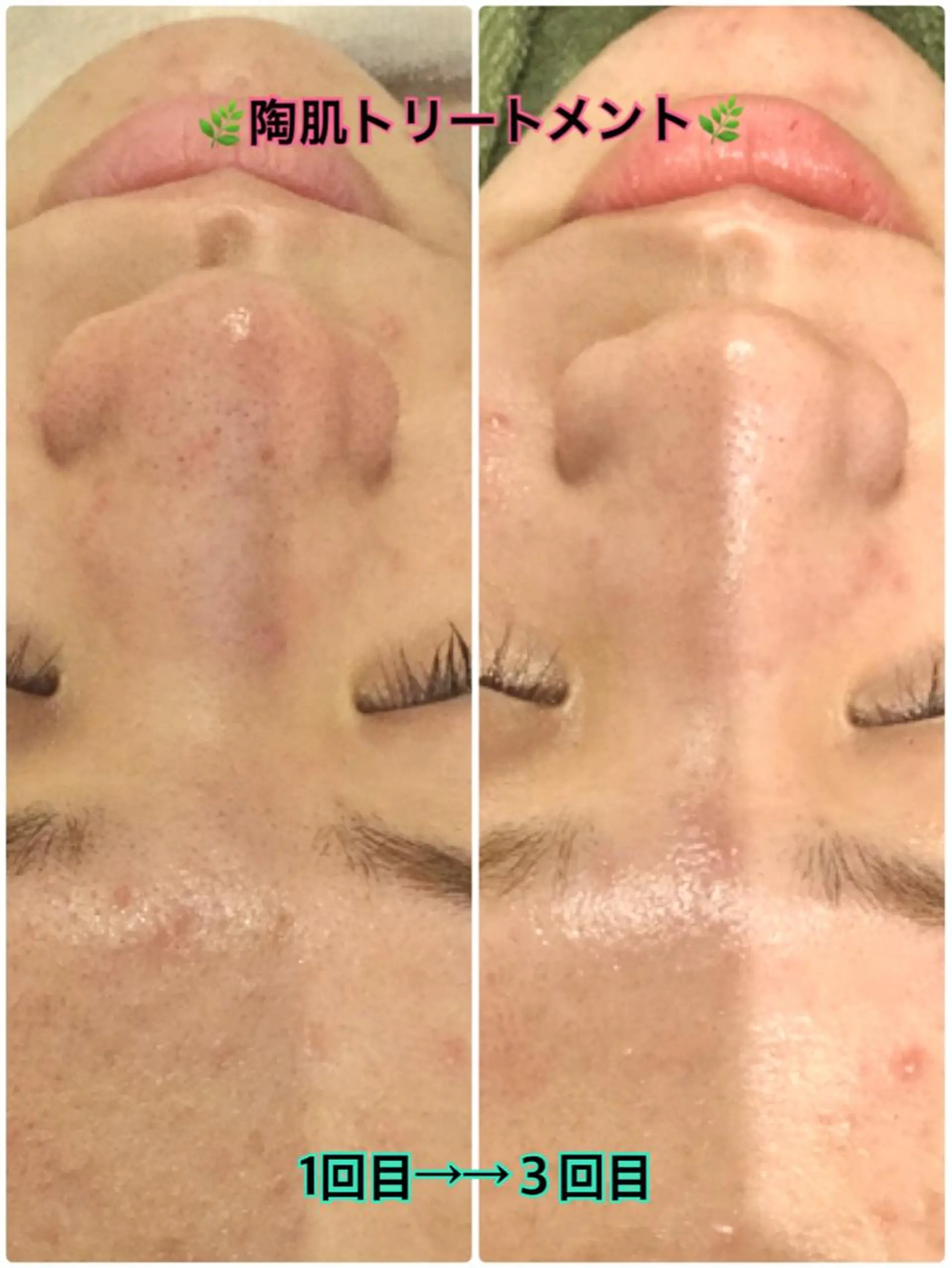 エステ 【リベルハーブピーリング認定店】敏感肌・美白脱毛専門店Dione立川店所属・Dione 立川店のエステ・リラクイメージ