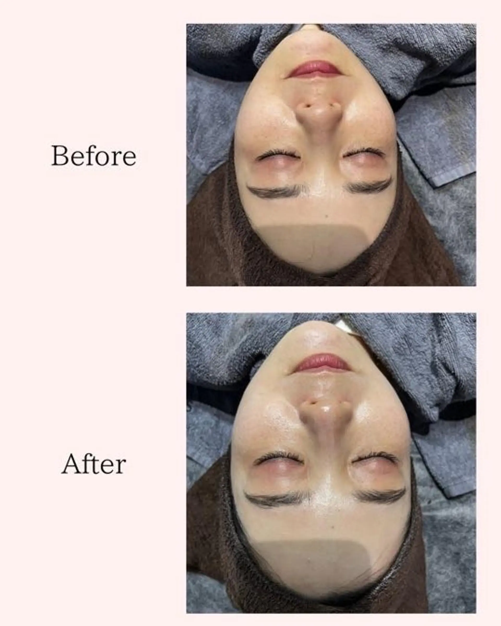 エステ ハーブピーリング🌿 REVI/Ayanoのエステ・リラクイメージ