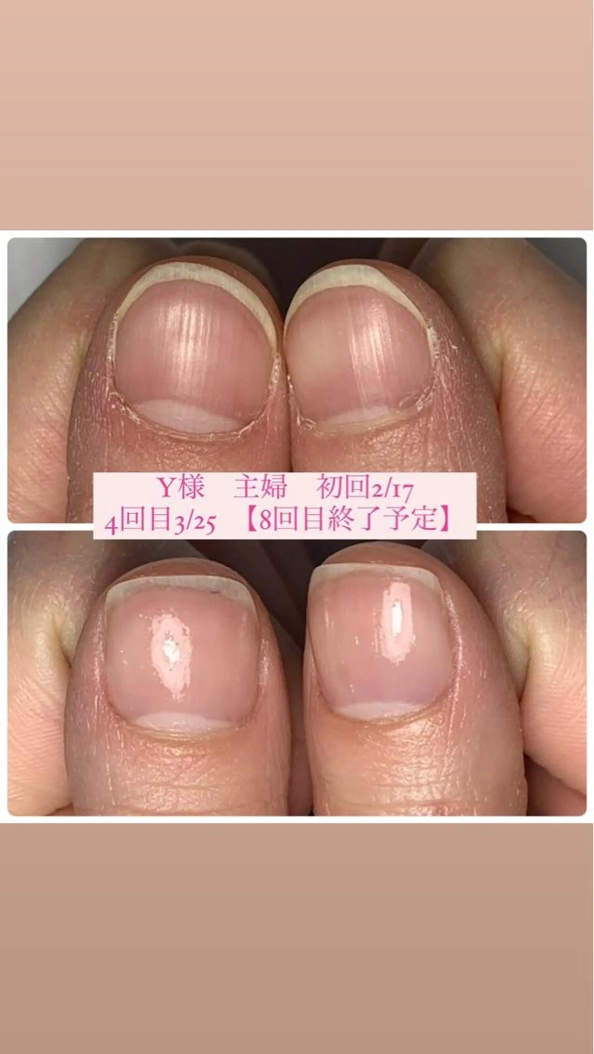 ネイル 自爪育成/深爪矯正 mikiのネイルデザイン