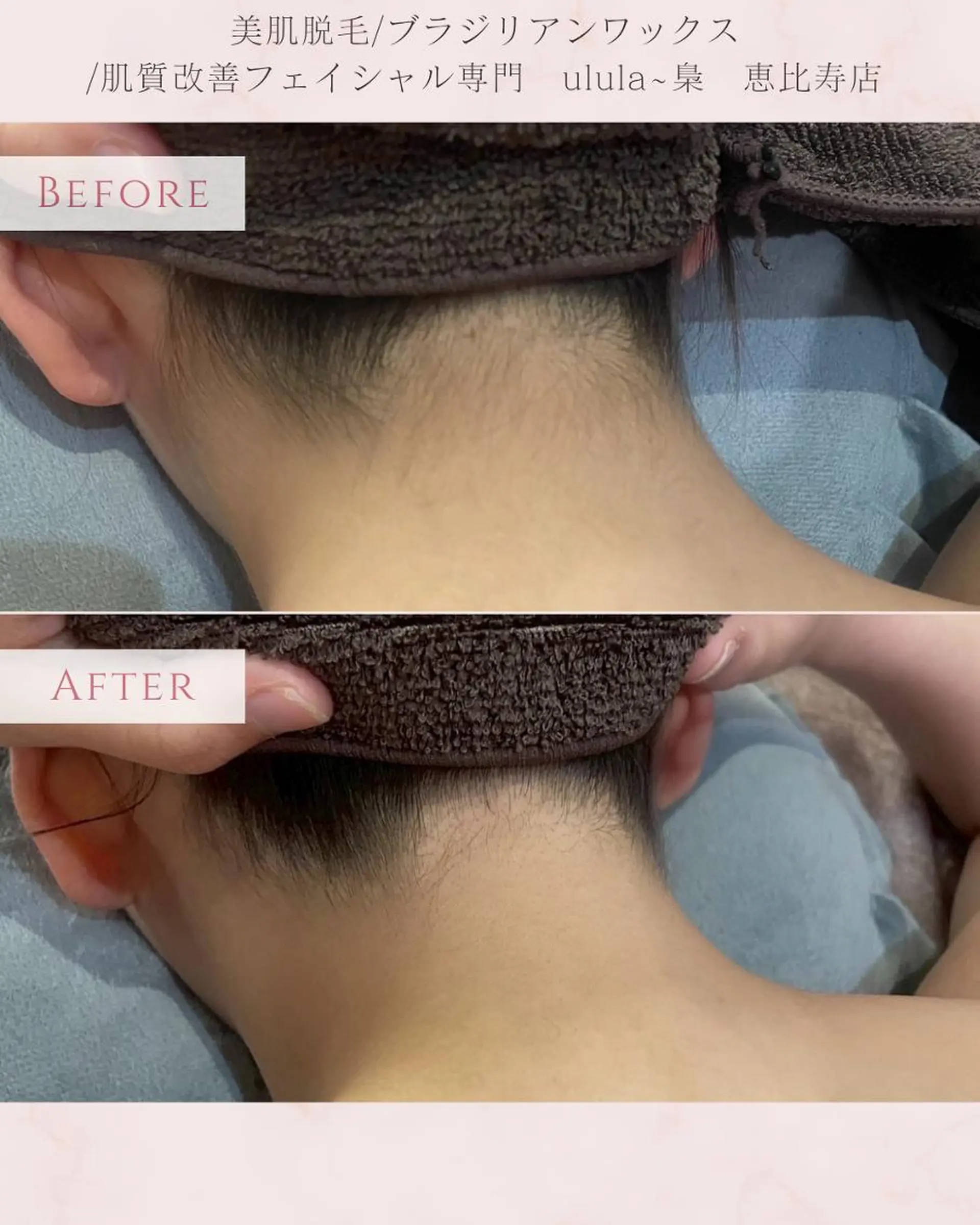 脱毛 美肌脱毛/肌質改善 《ulula～梟》のエステ・リラクイメージ