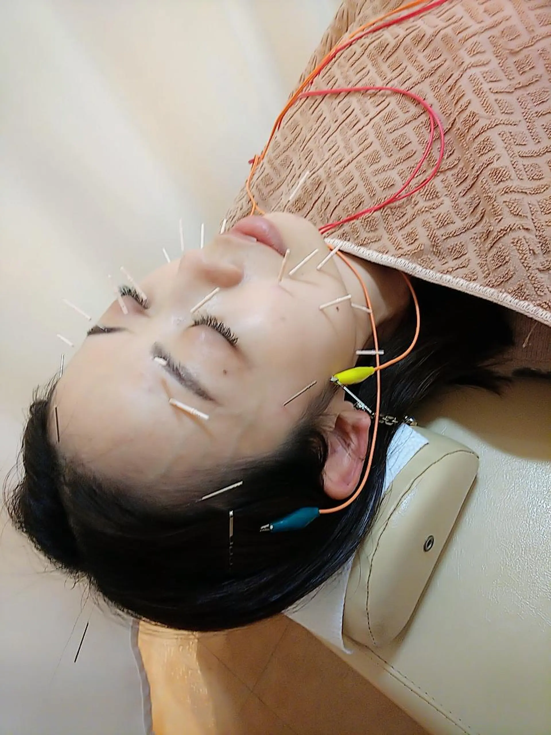 リフトアップ・たるみ ☆美容鍼小顔矯正のその他イメージ