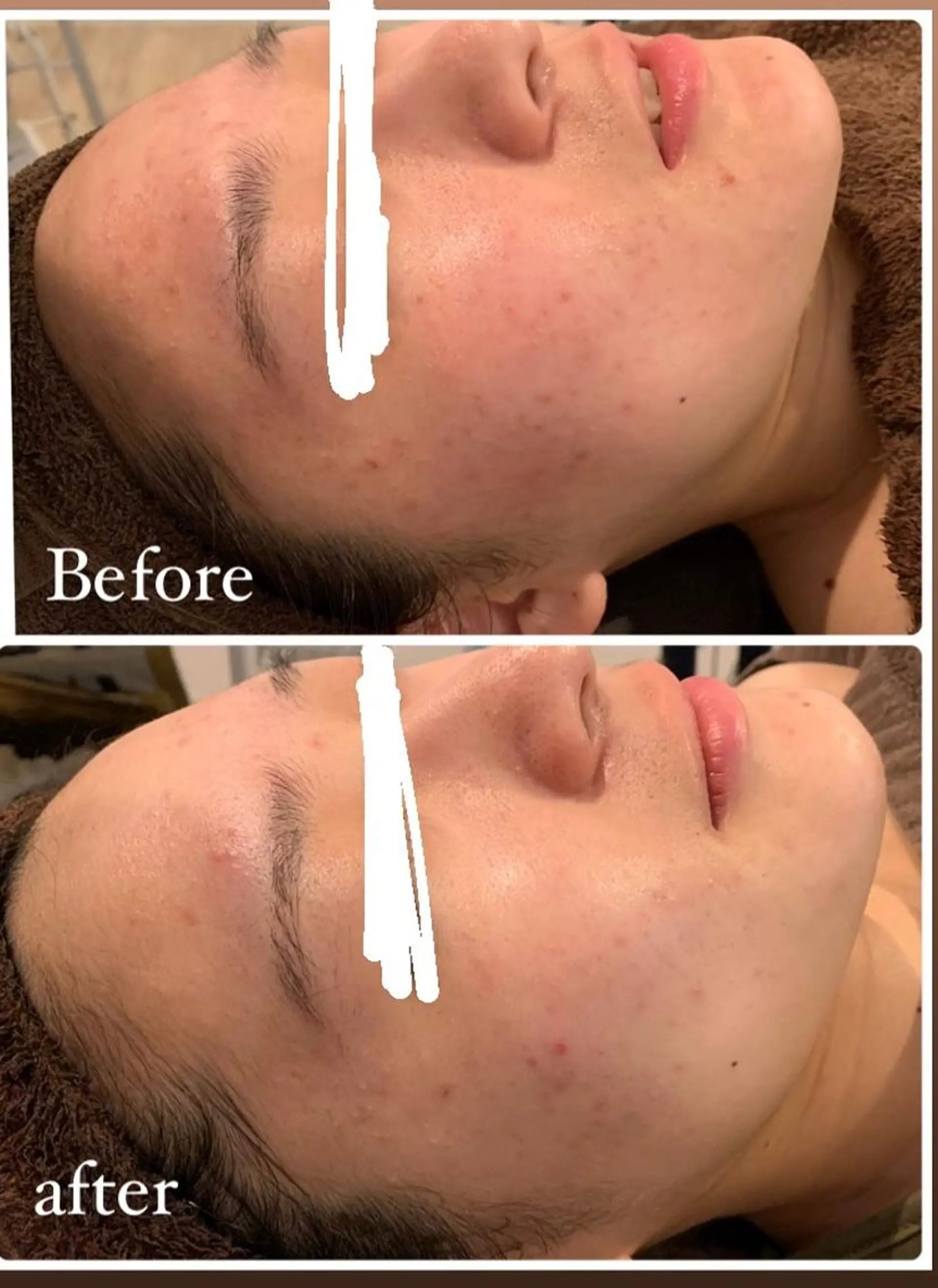 肌質改善ハーブピー リング🌿RINAのエステ・リラクイメージ