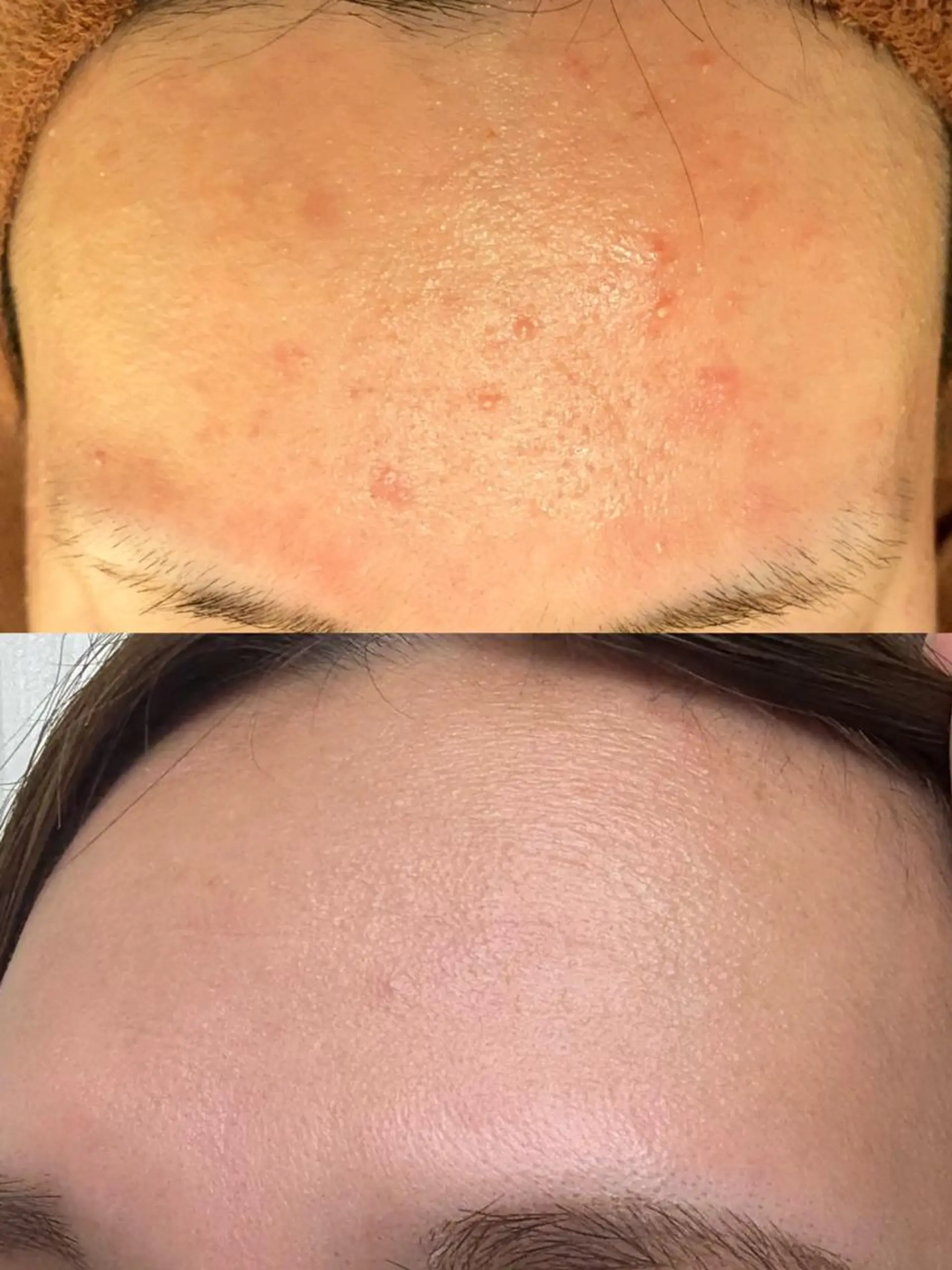 ニキビ跡改善専門🔥 医療にはできない改善のエステ・リラクイメージ