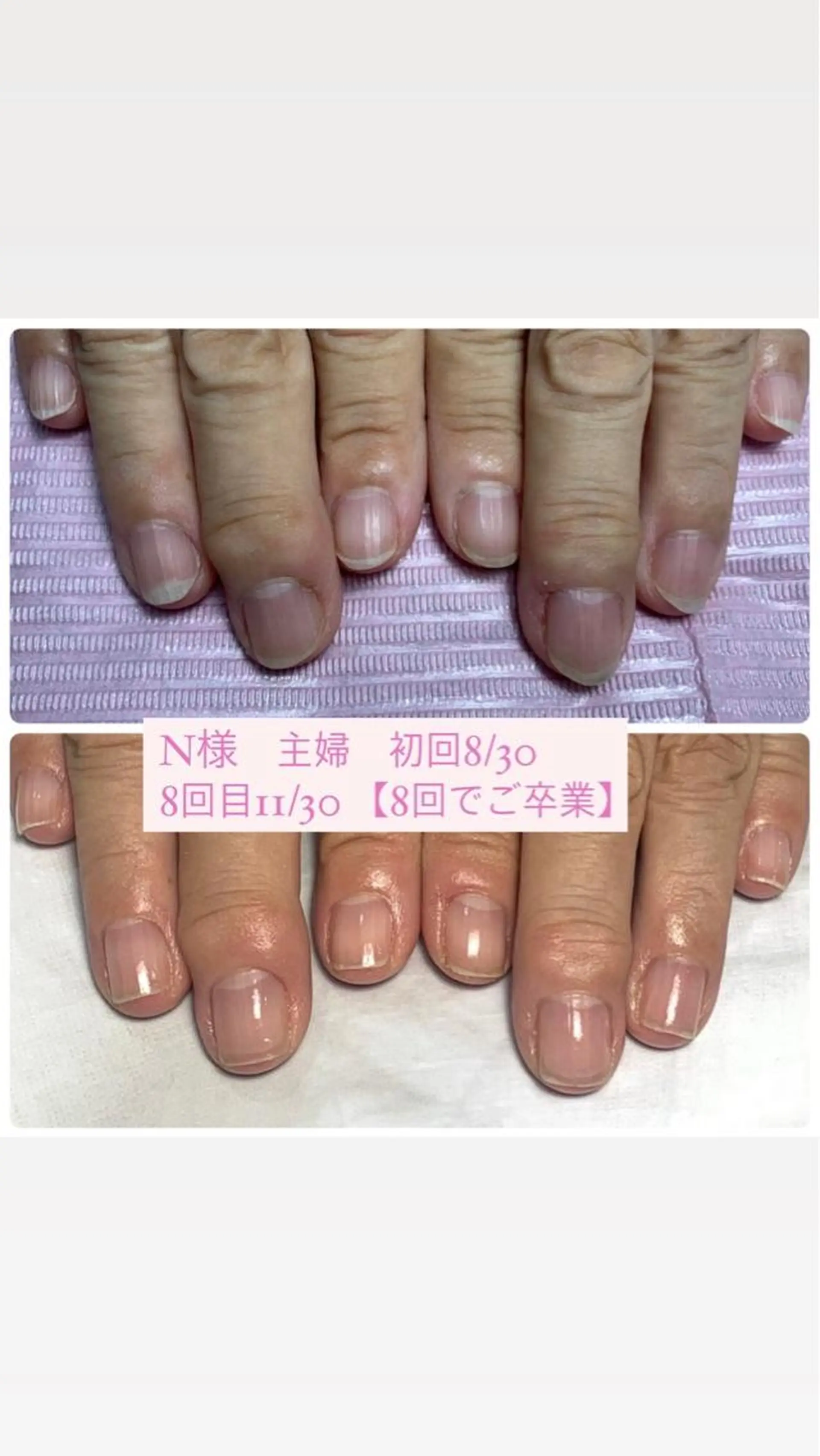 ネイル 自爪育成/深爪矯正 mikiのネイルデザイン