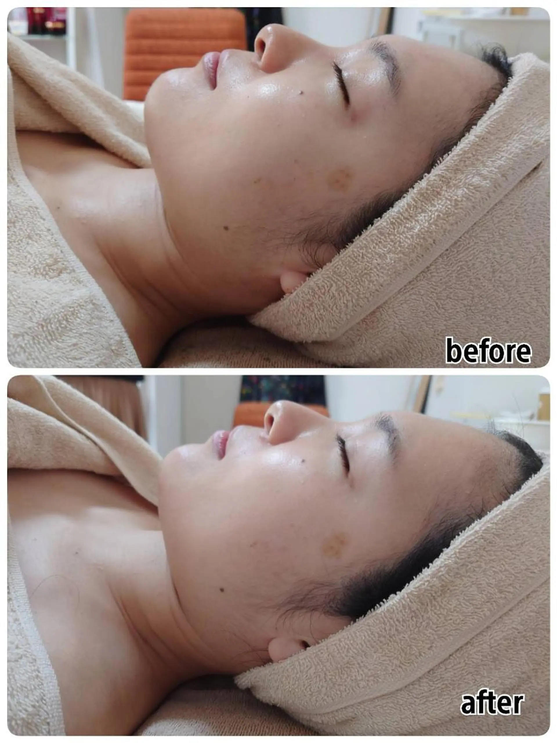 ニキビ・毛穴改善 🌿ハーブピーリングのエステ・リラクイメージ