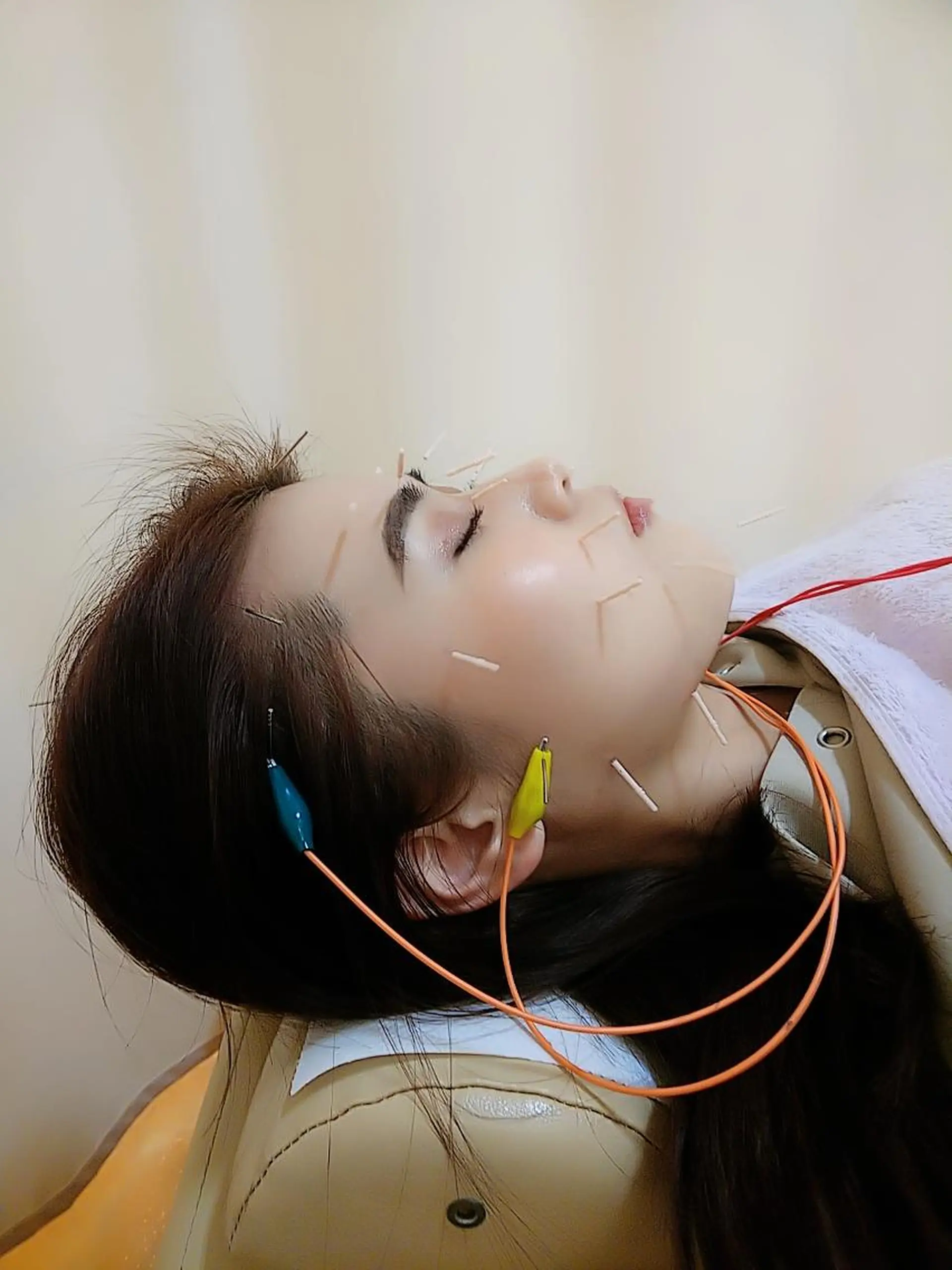 リフトアップ・たるみ ☆美容鍼小顔矯正のその他イメージ