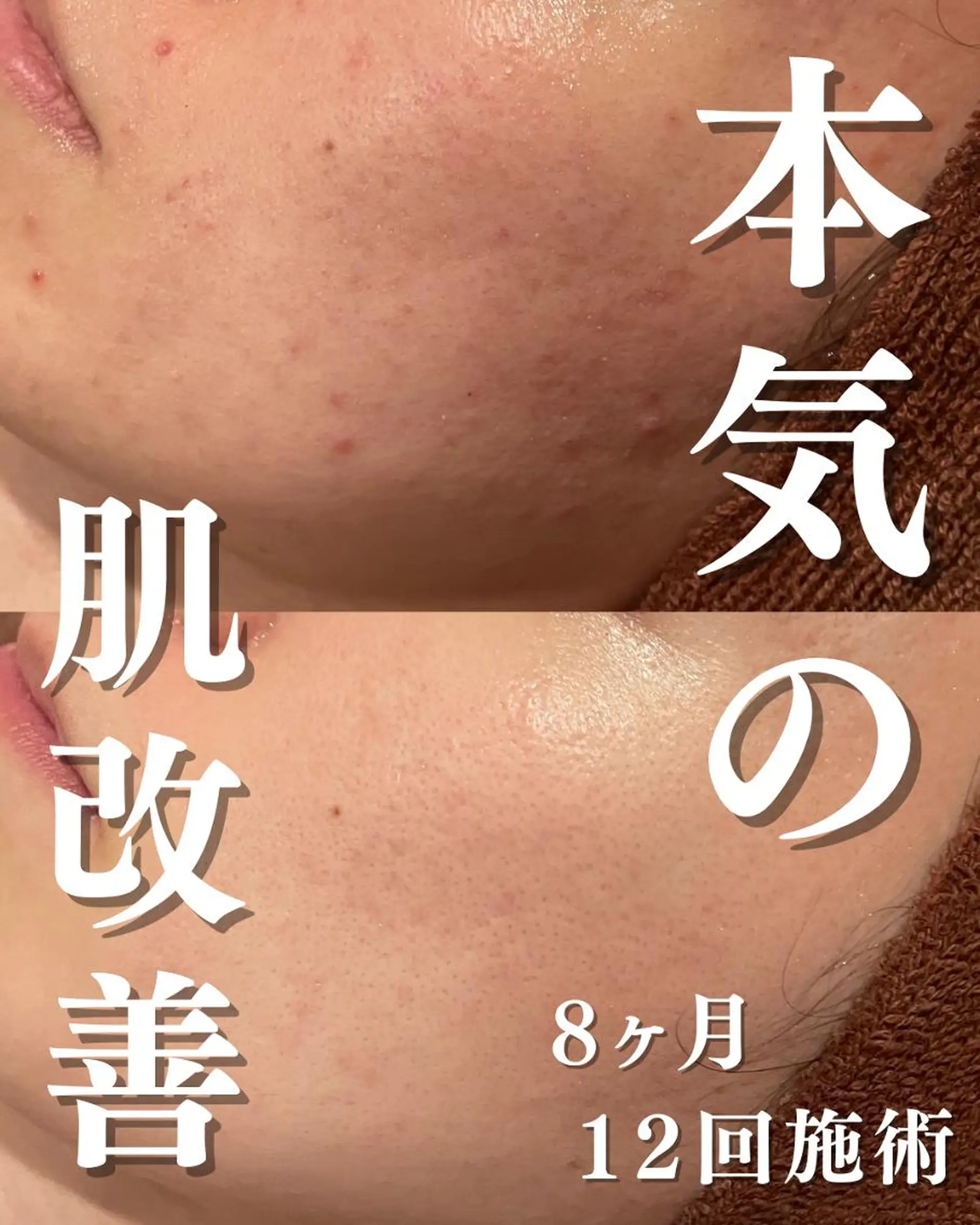 都内で出来る肌管理！ 最短ニキビ改善のエステ・リラクイメージ