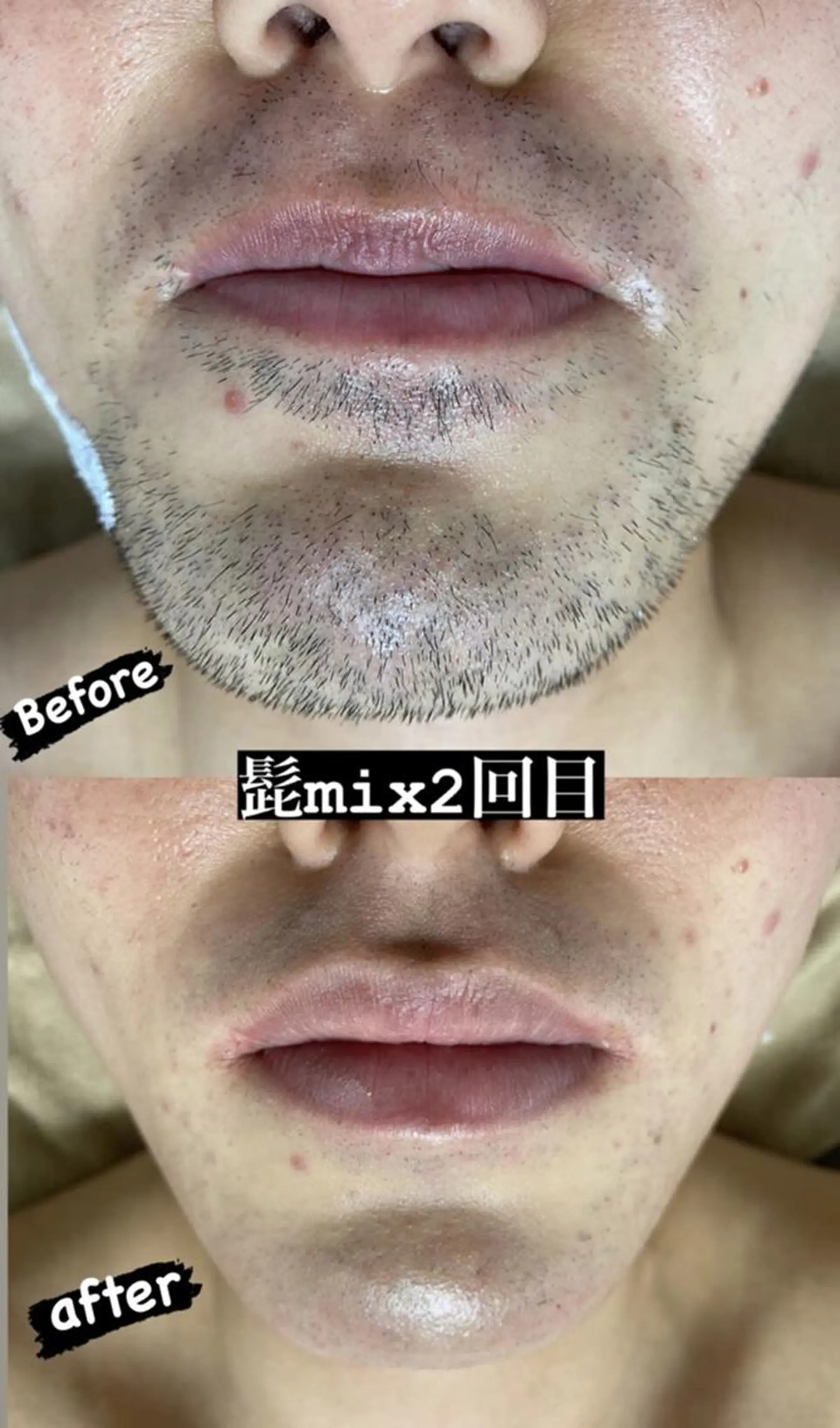 キッズ メンズ 脱毛 Epina 千葉店 【エピナ】のエステ・リラクイメージ