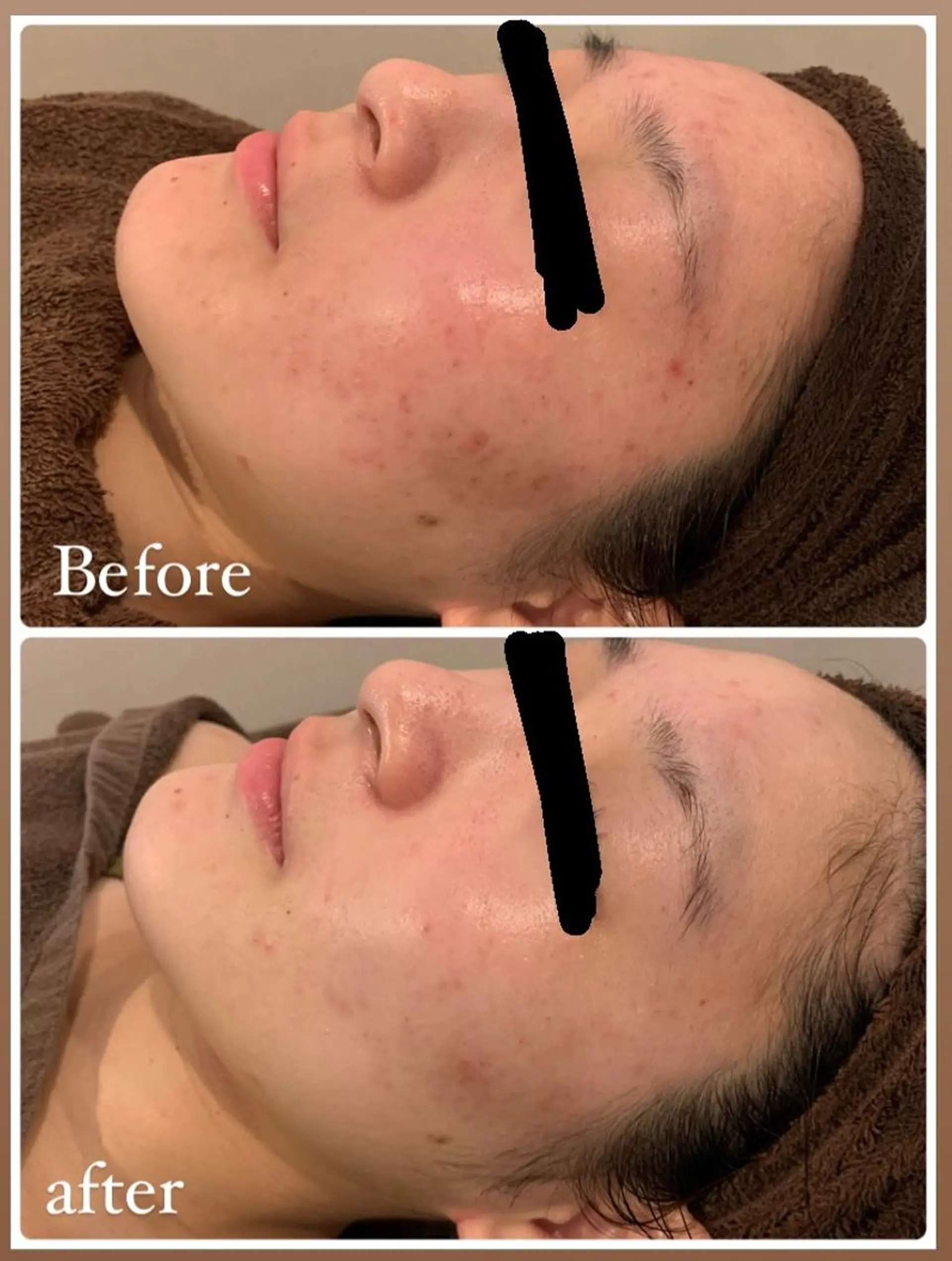 エステ リラク 肌質改善ハーブピー リング🌿RINAのエステ・リラクイメージ