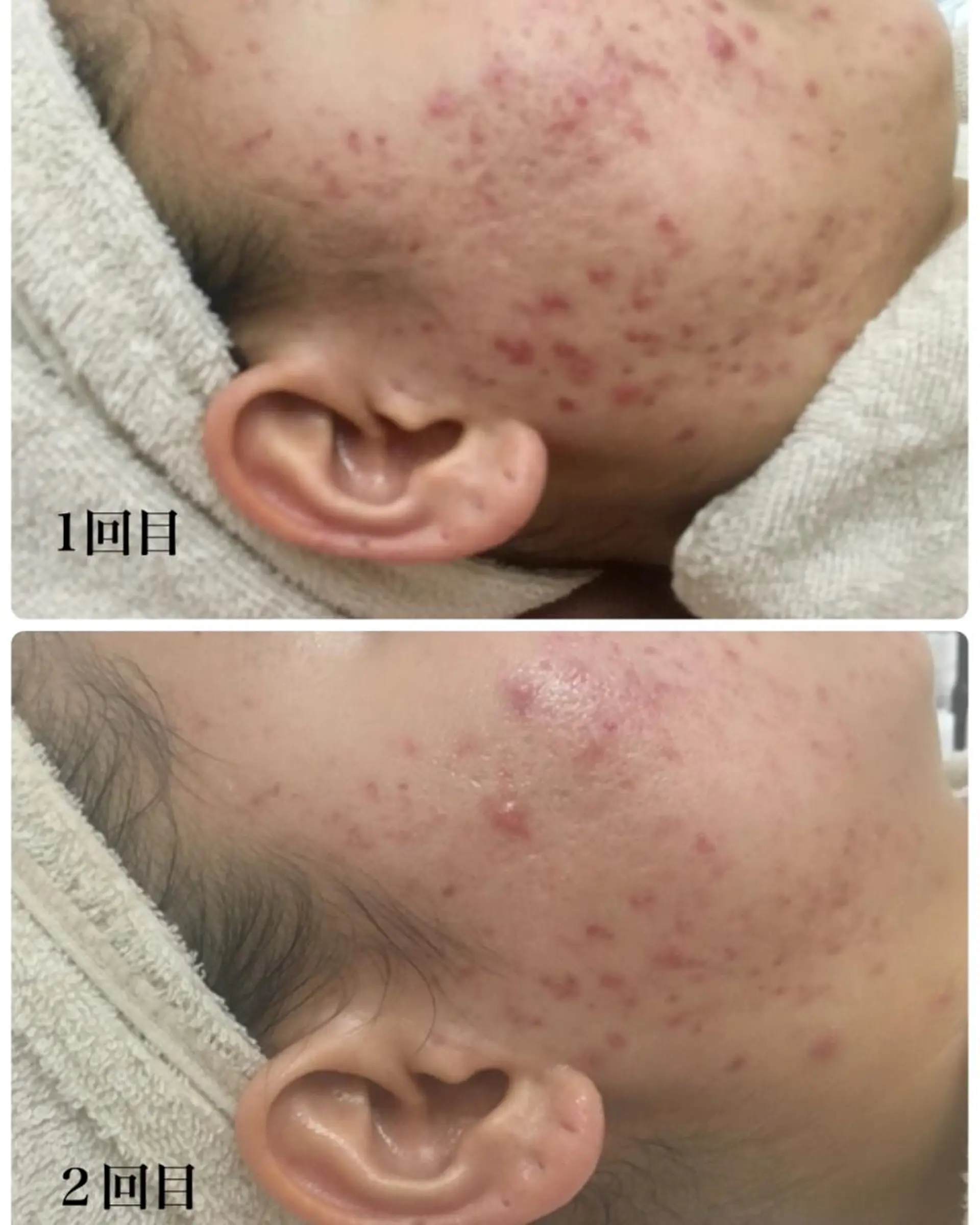 Meupニキビ専門店 背中/ハーブ/肌管理のその他イメージ