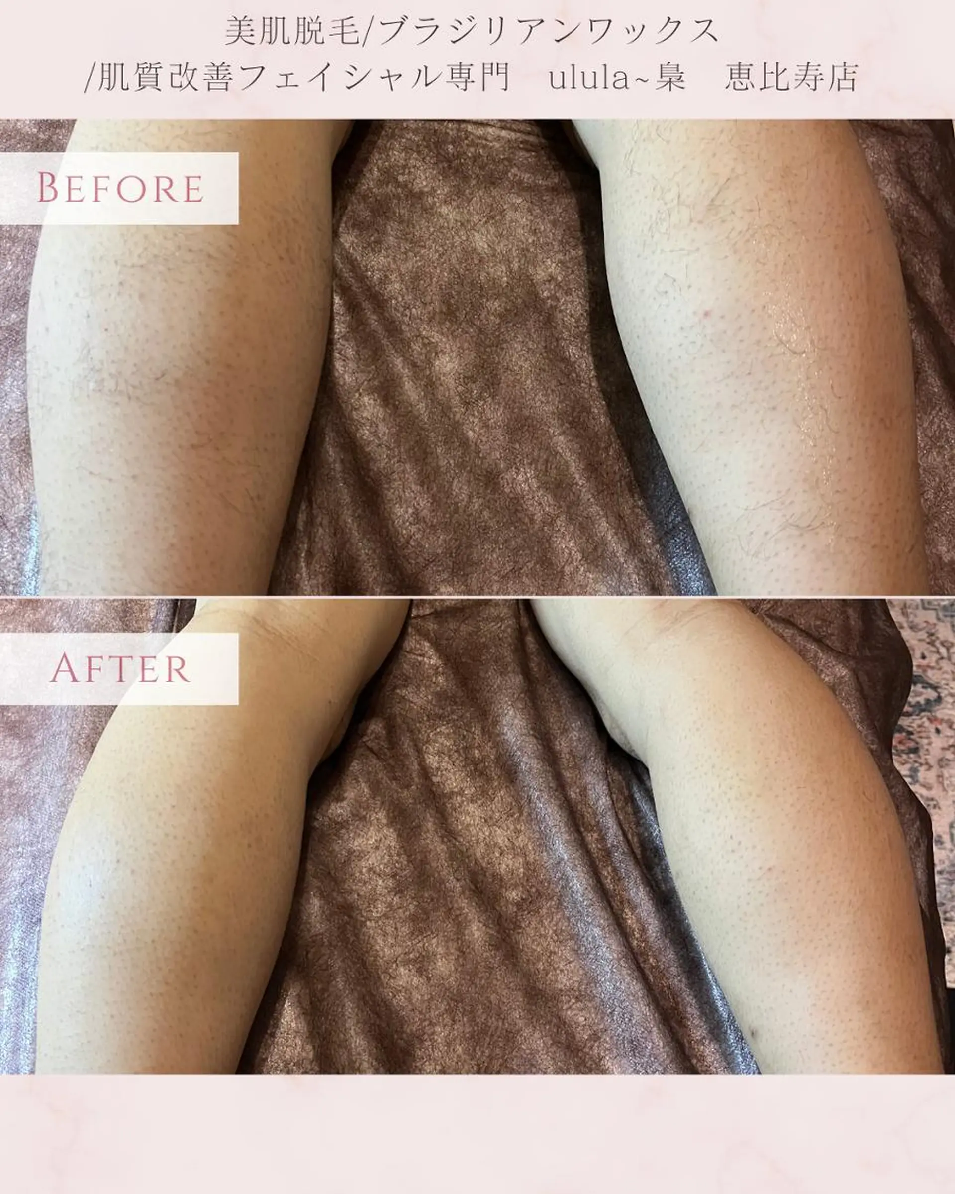 脱毛 美肌脱毛/肌質改善 《ulula～梟》のエステ・リラクイメージ