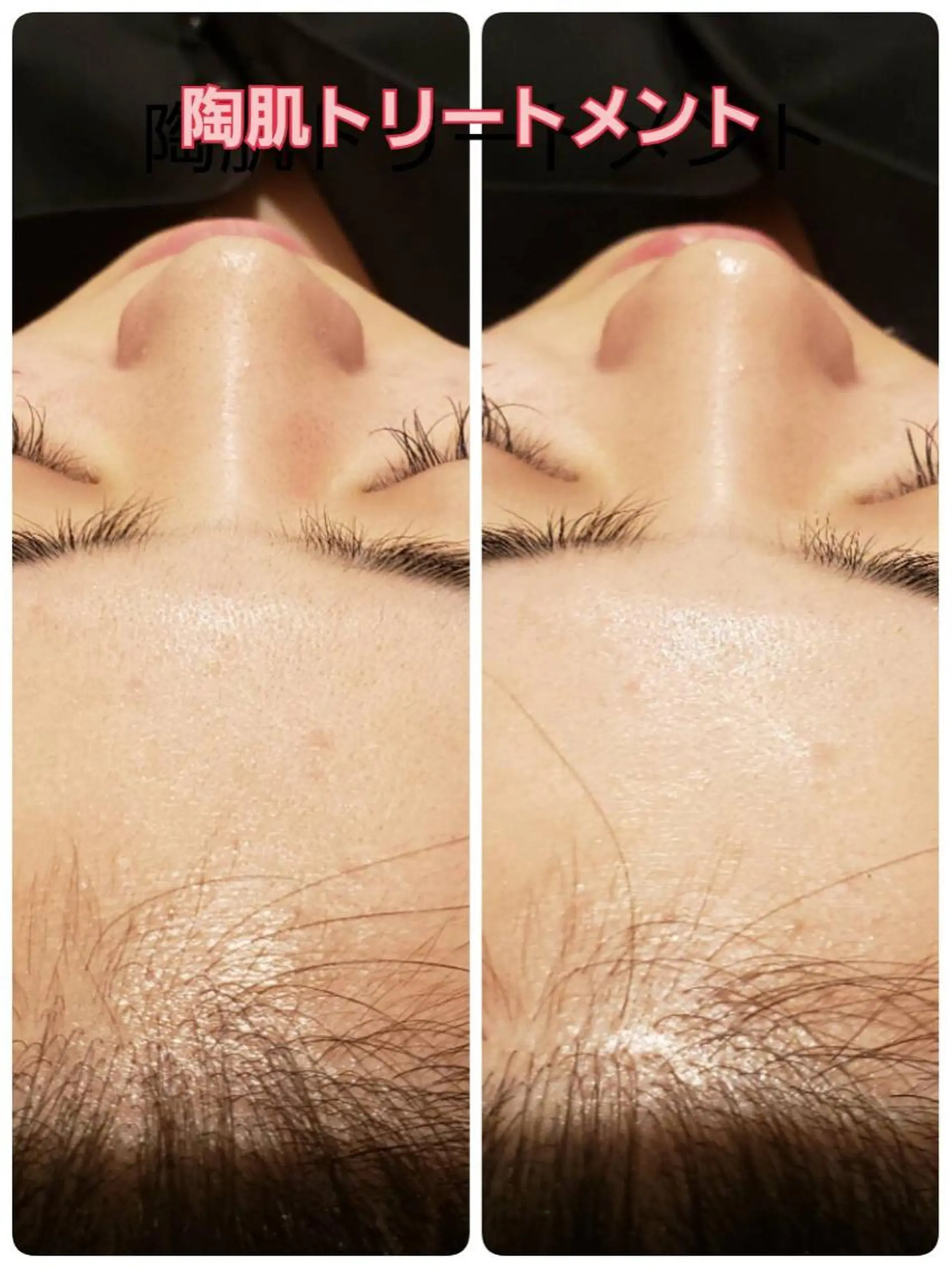 エステ 【リベルハーブピーリング認定店】敏感肌・美白脱毛専門店Dione立川店所属・Dione 立川店のエステ・リラクイメージ