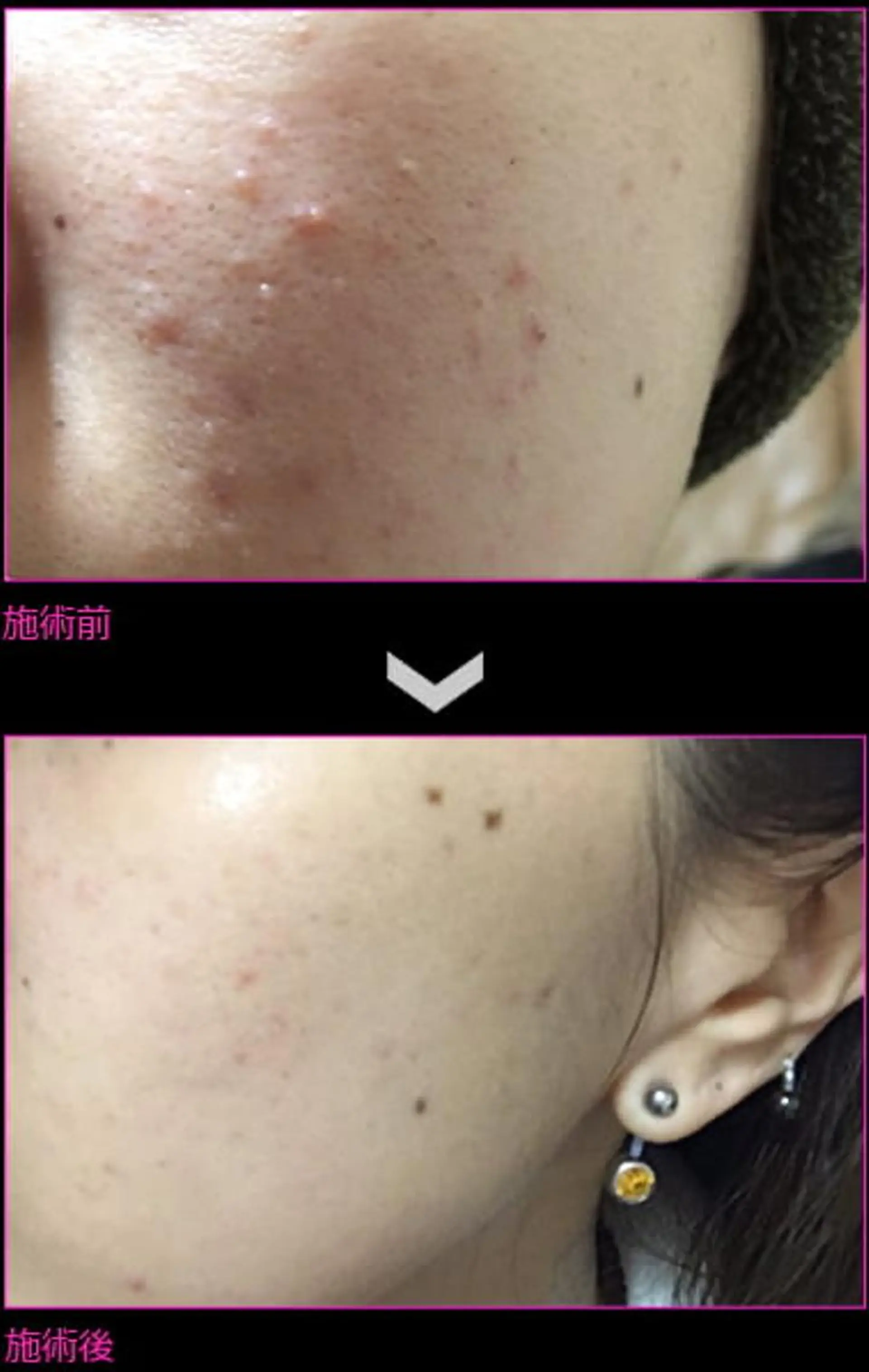 ハーブピーリング/韓国肌管理/フェイシャル/毛穴洗浄/眉毛/顔脱毛【糸脱毛専門】rev所属・ハーブピーリング🌹 毛穴洗浄❤️眉waxのエステ・リラクイメージ