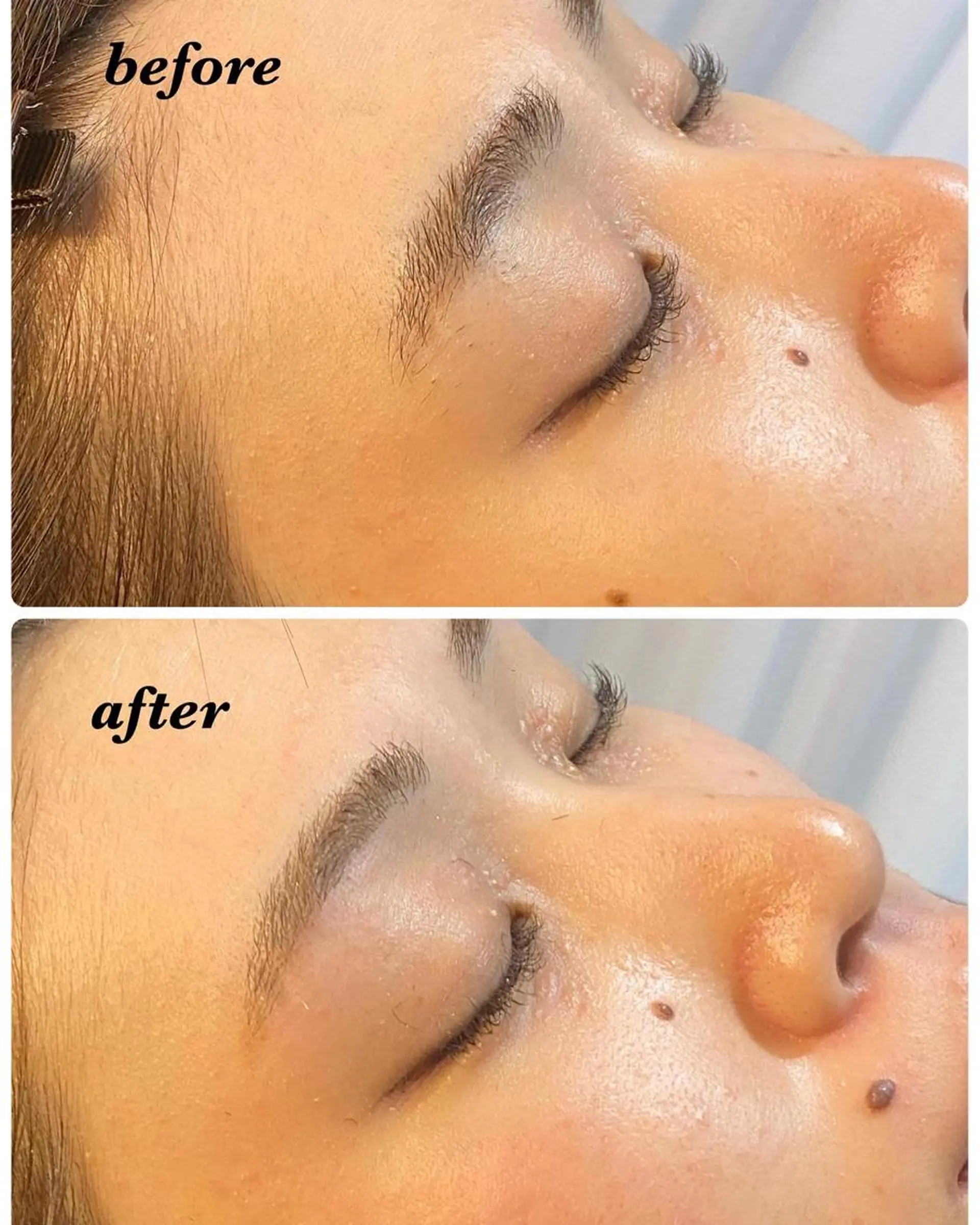 アイブロウ ハーブピーリング/韓国肌管理/フェイシャル/毛穴洗浄/眉毛/顔脱毛【糸脱毛専門】rev所属・ハーブピーリング🌹 毛穴洗浄❤️眉waxのエステ・リラクイメージ