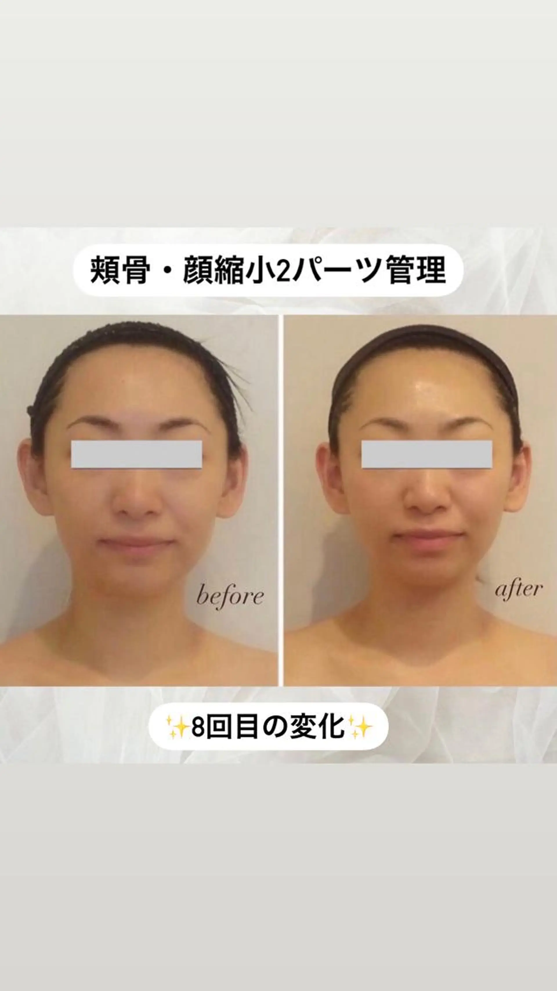 エステ リラク 整形級の変化👀 最新✨韓国小顔管理のエステ・リラクイメージ
