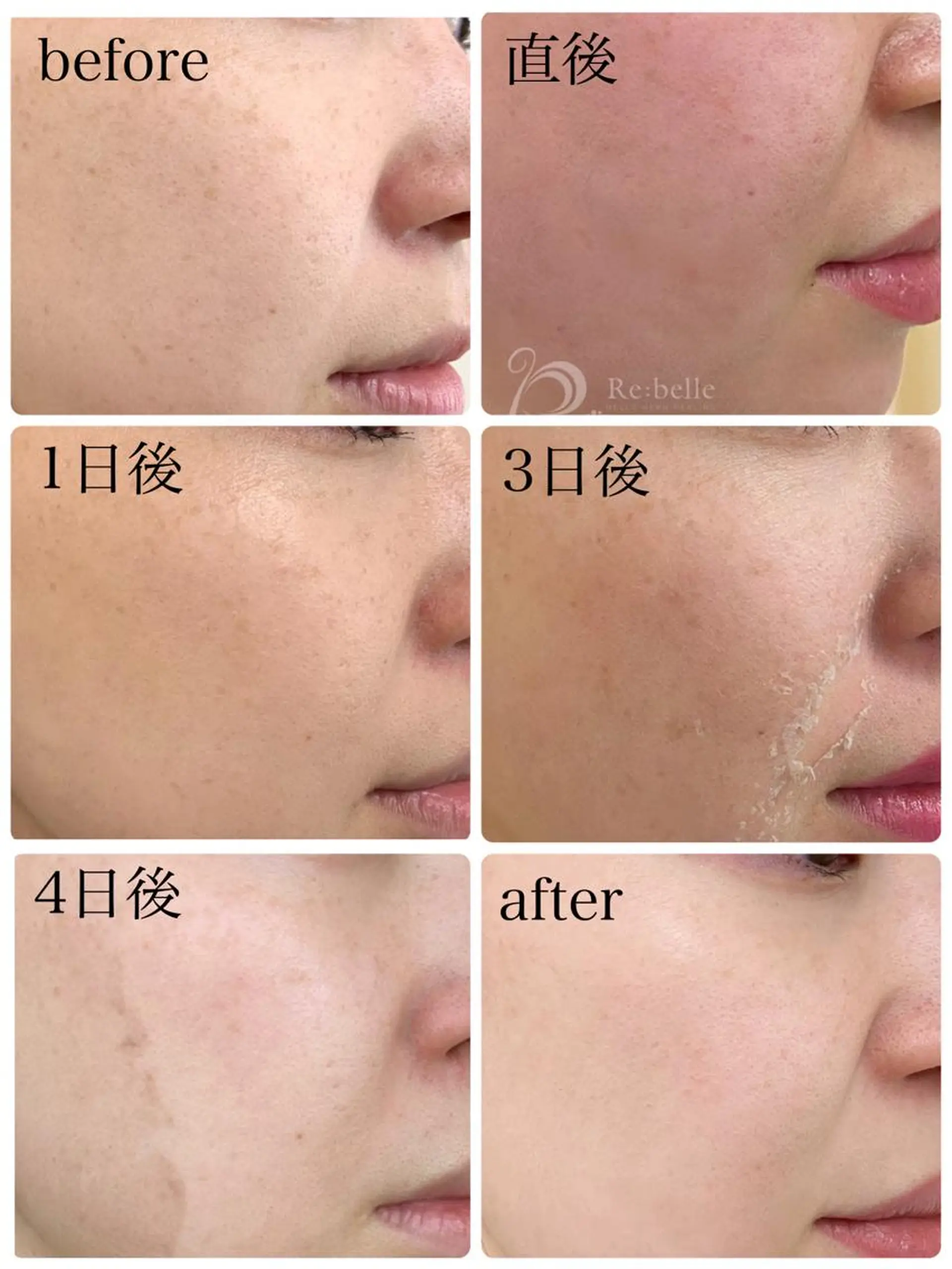 エステ BeSkin藤沢店所属・ニキビ/肌質改善 BeSkin 藤沢店のエステ・リラクイメージ