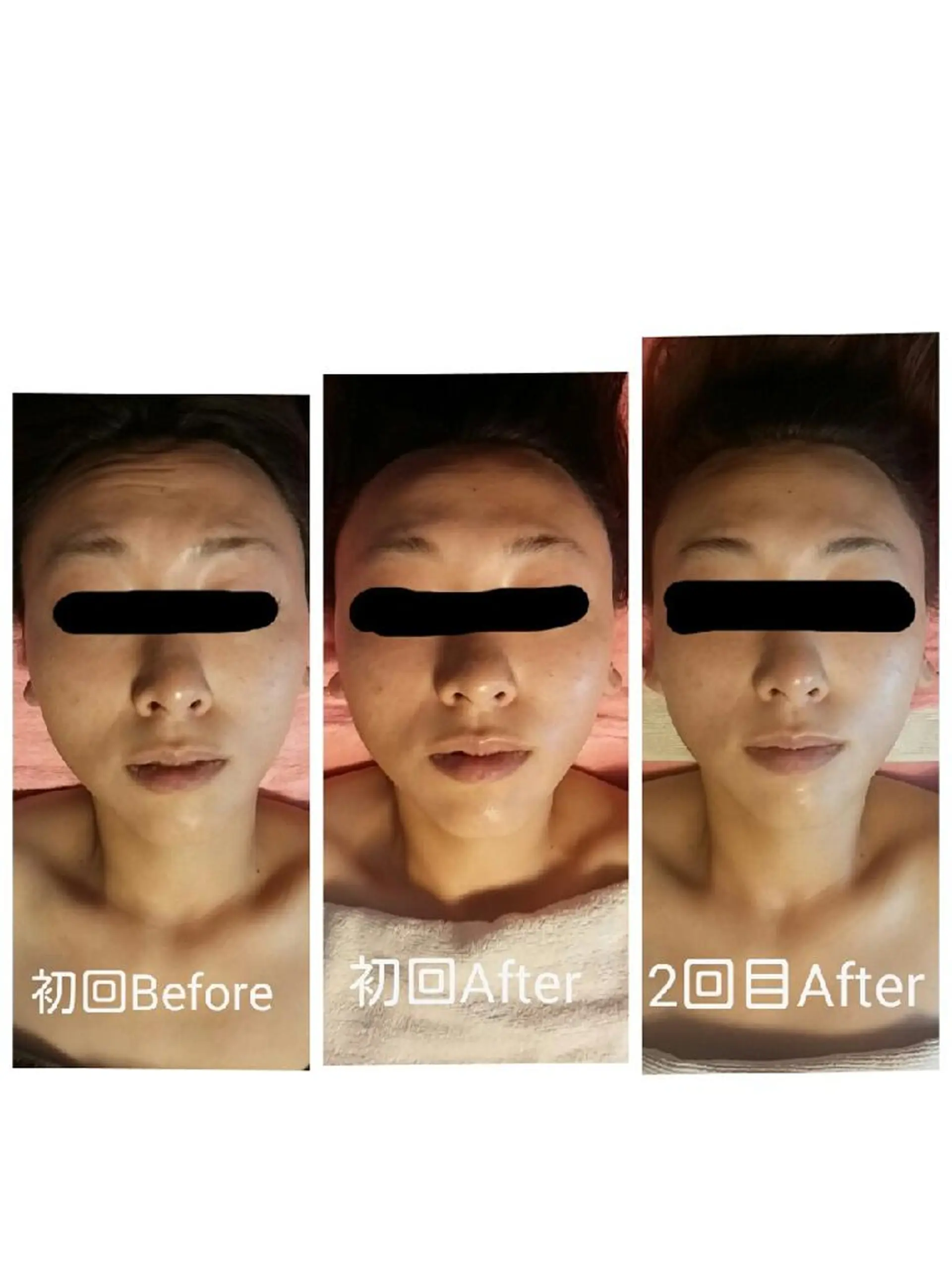 毛穴ケア くすみ肌 ハーブピーリングのエステ・リラクイメージ