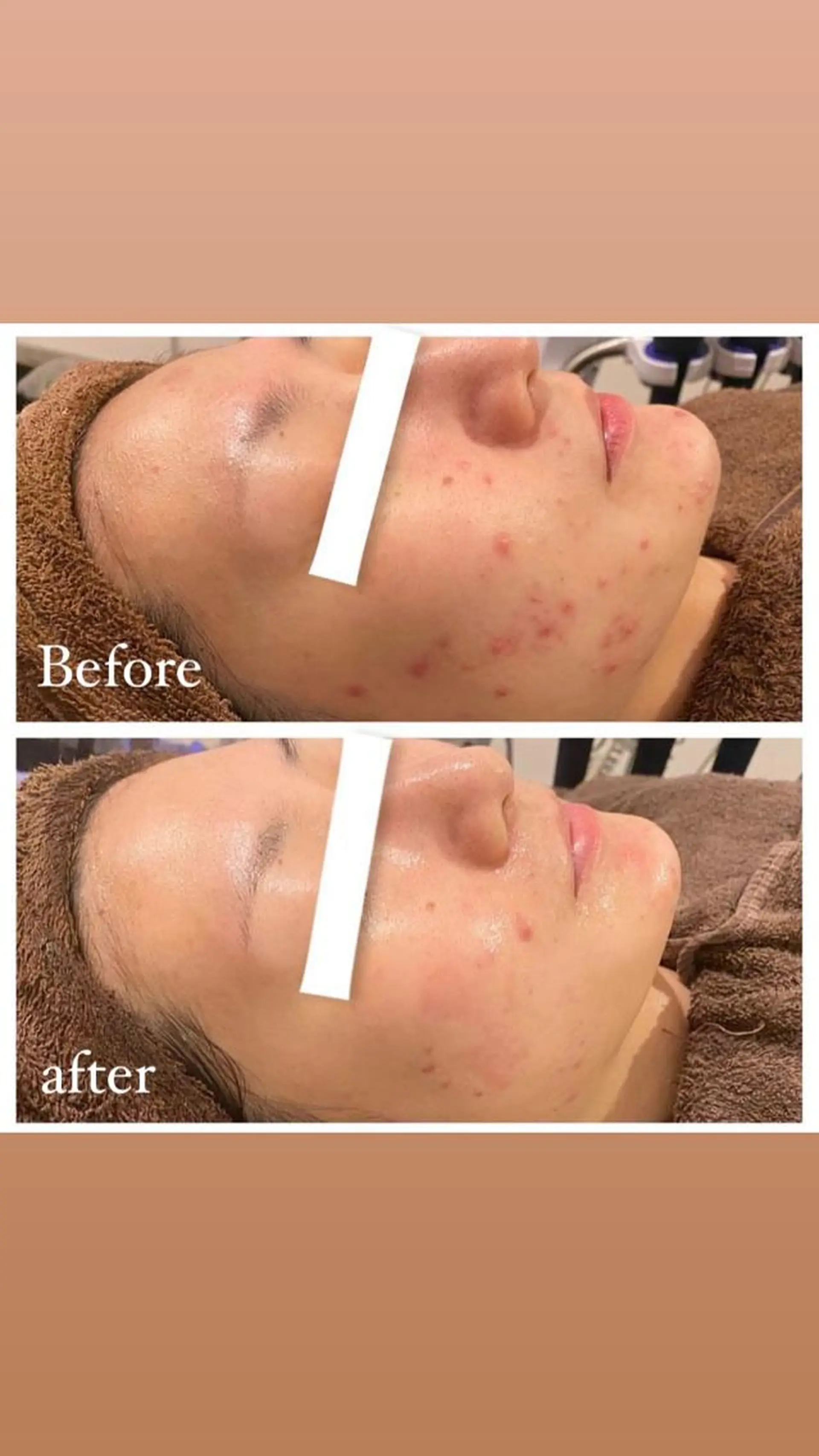 エステ リラク 肌質改善ハーブピー リング🌿RINAのエステ・リラクイメージ