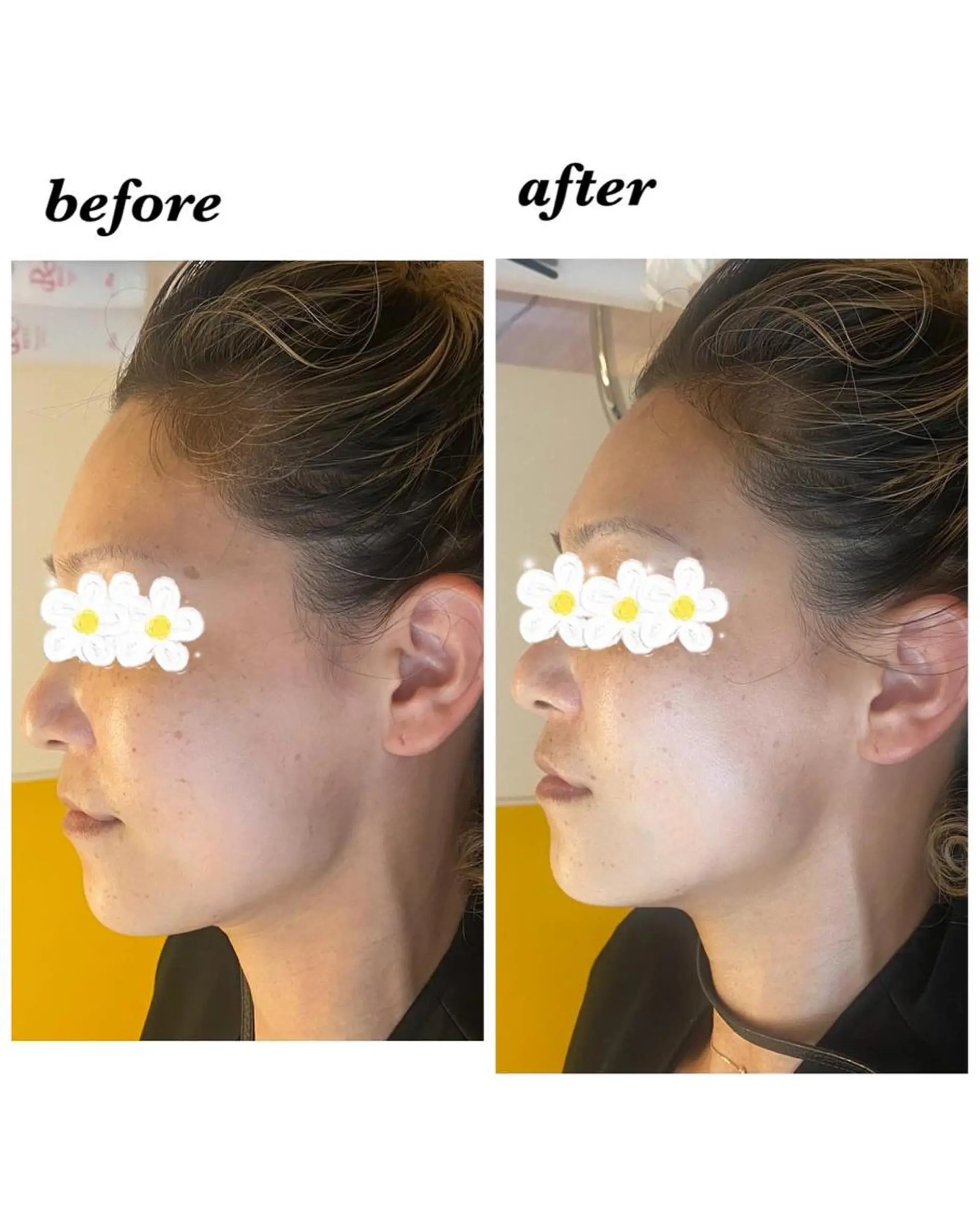 ハーブピーリング/韓国肌管理/フェイシャル/毛穴洗浄/眉毛/顔脱毛【糸脱毛専門】rev所属・ハーブピーリング🌹 毛穴洗浄❤️眉waxのエステ・リラクイメージ