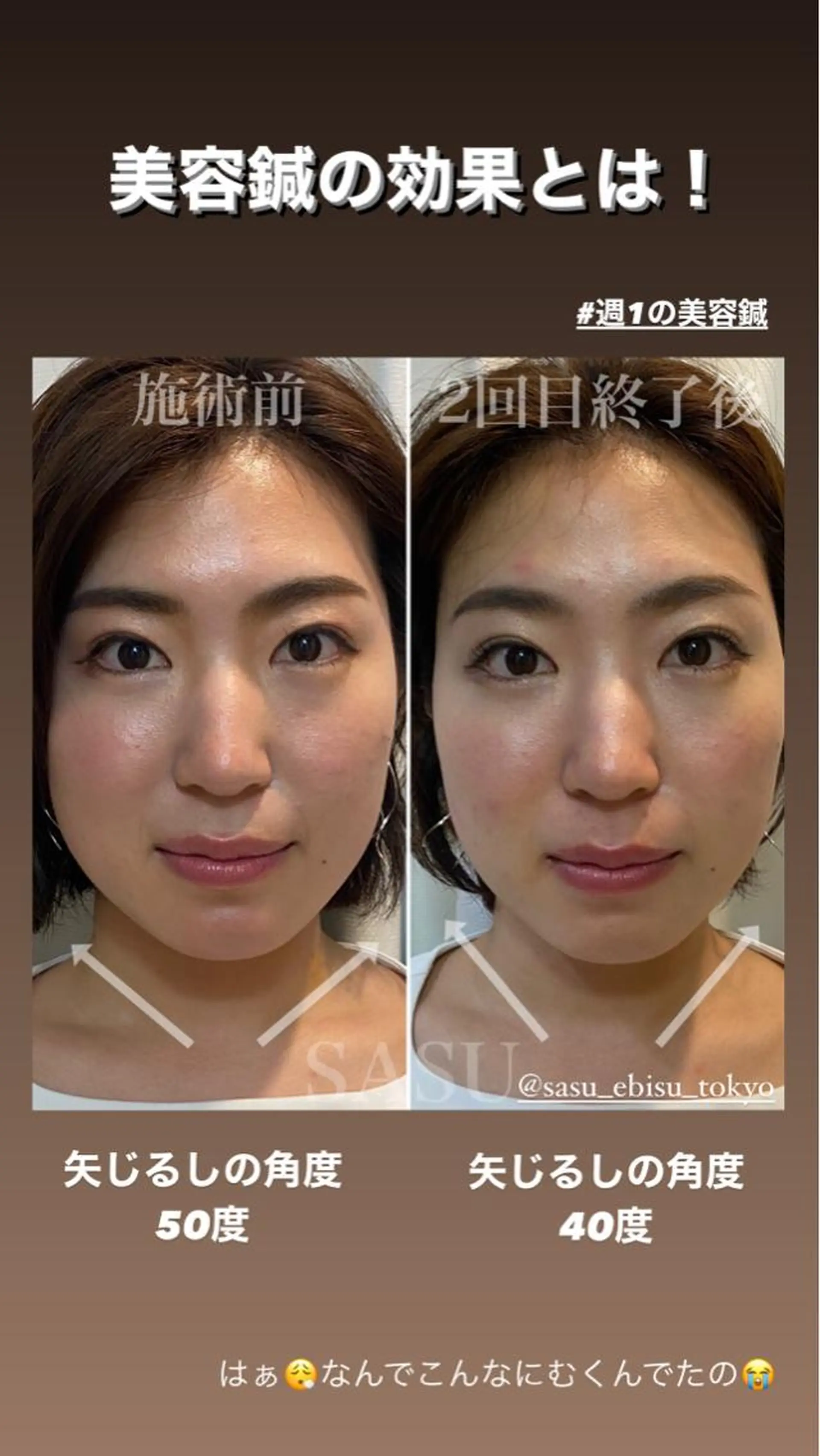 カラー パーマ ヘアアレンジ メンズ キッズ マツエク・マツパ アイブロウ その他 即小顔♥️美容鍼× ハーブピーリングのその他イメージ